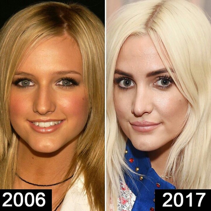 Ashlee Simpson Botchedsurgeries