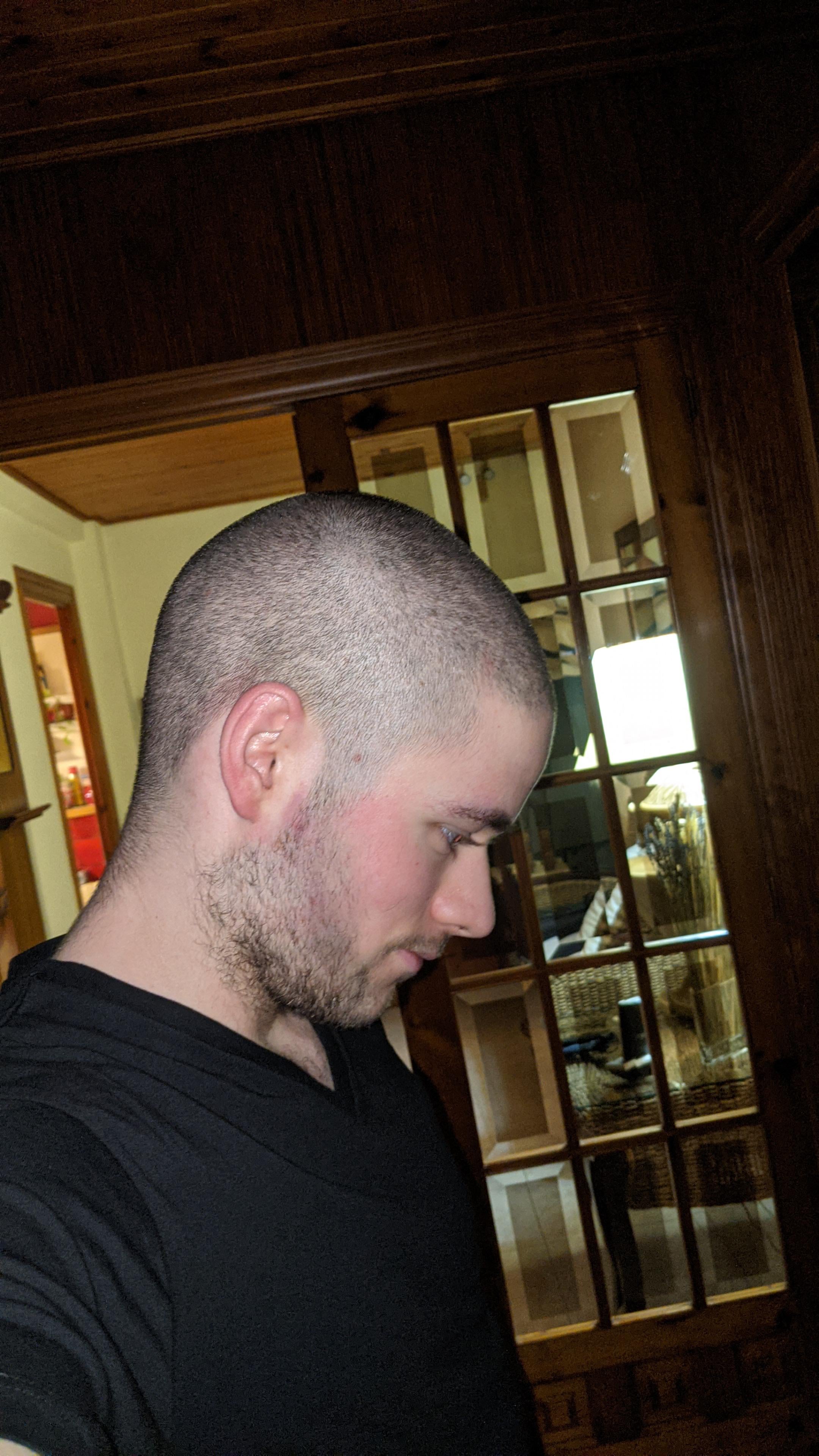 how much are hair plugs reddit Annamae Pendleton