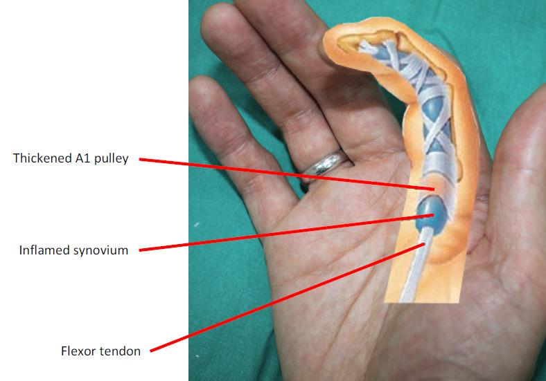 What happens with A1 pulley after release surgery? Does it heal? Is it