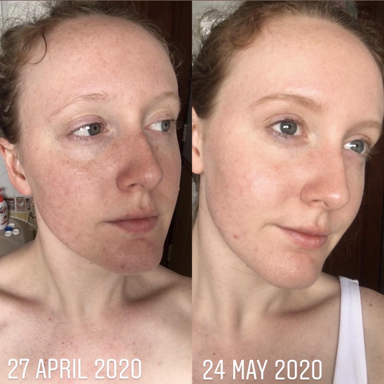 [B&A] Coming up to using Niacinamide 10 + Zinc AM and PM, and on week 2 of HA. I’m impressed to