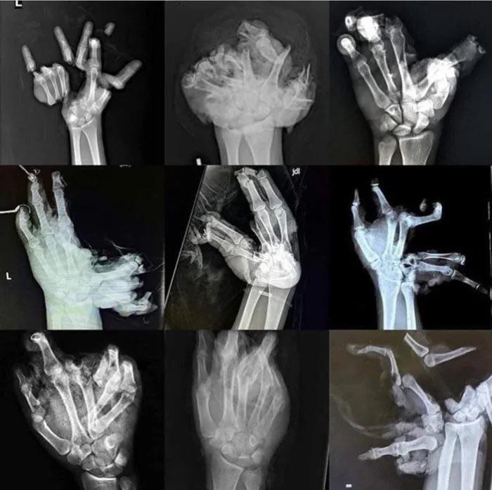 Xrays of fireworksrelated injuries r/oddlyterrifying
