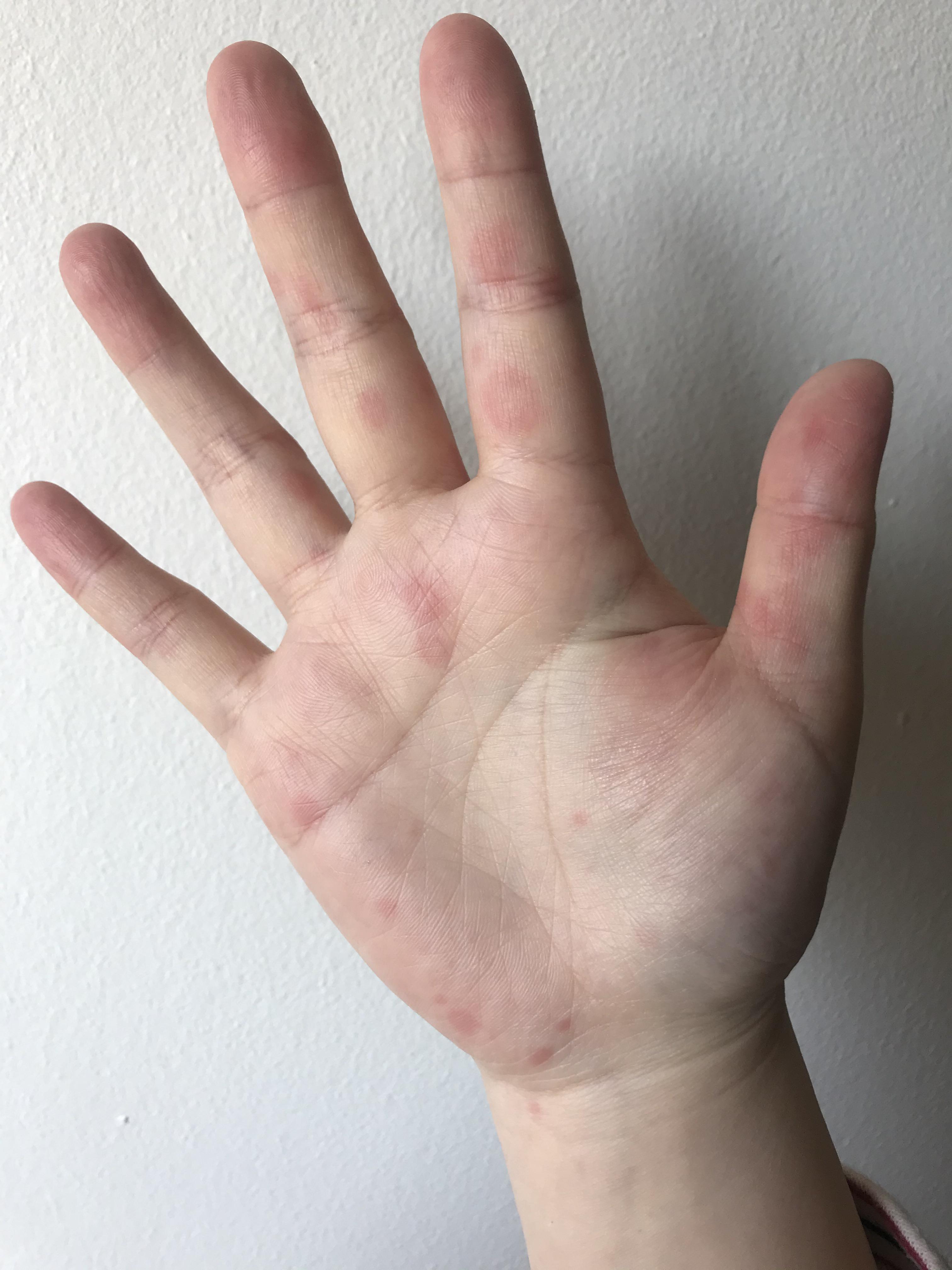 Urticaria Hand