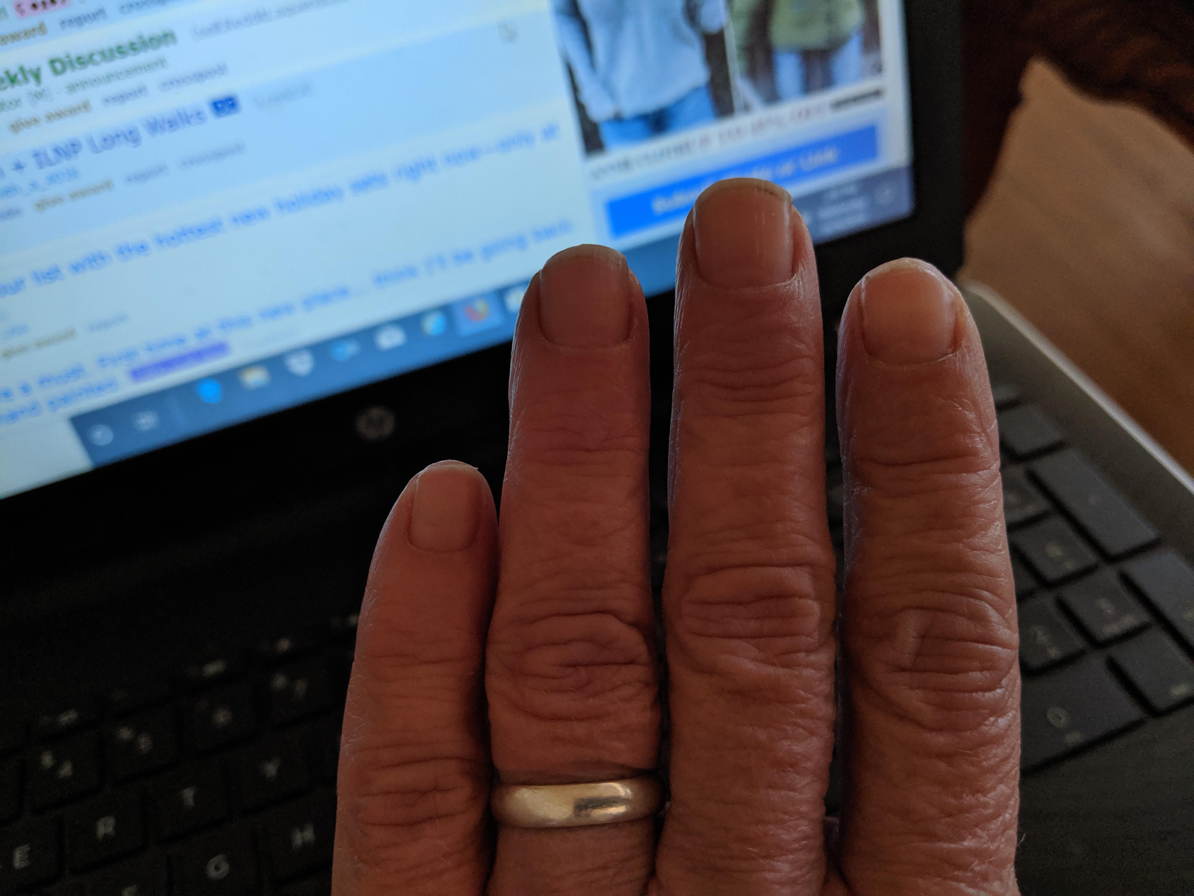 Recently got annoyed and cut my nails off. Ridges and dents are