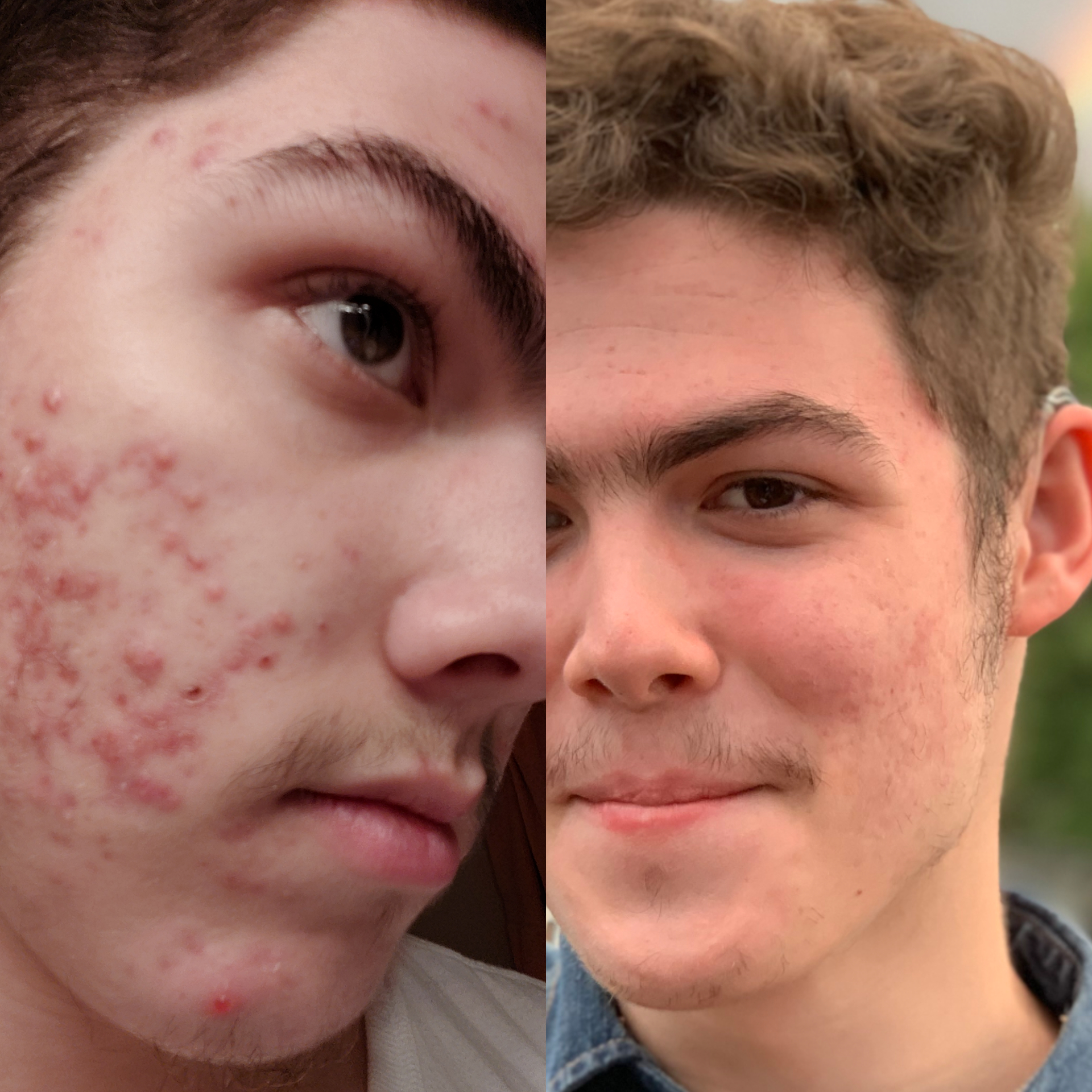 The sixmonth glow up with accutane. Always remember the light at the