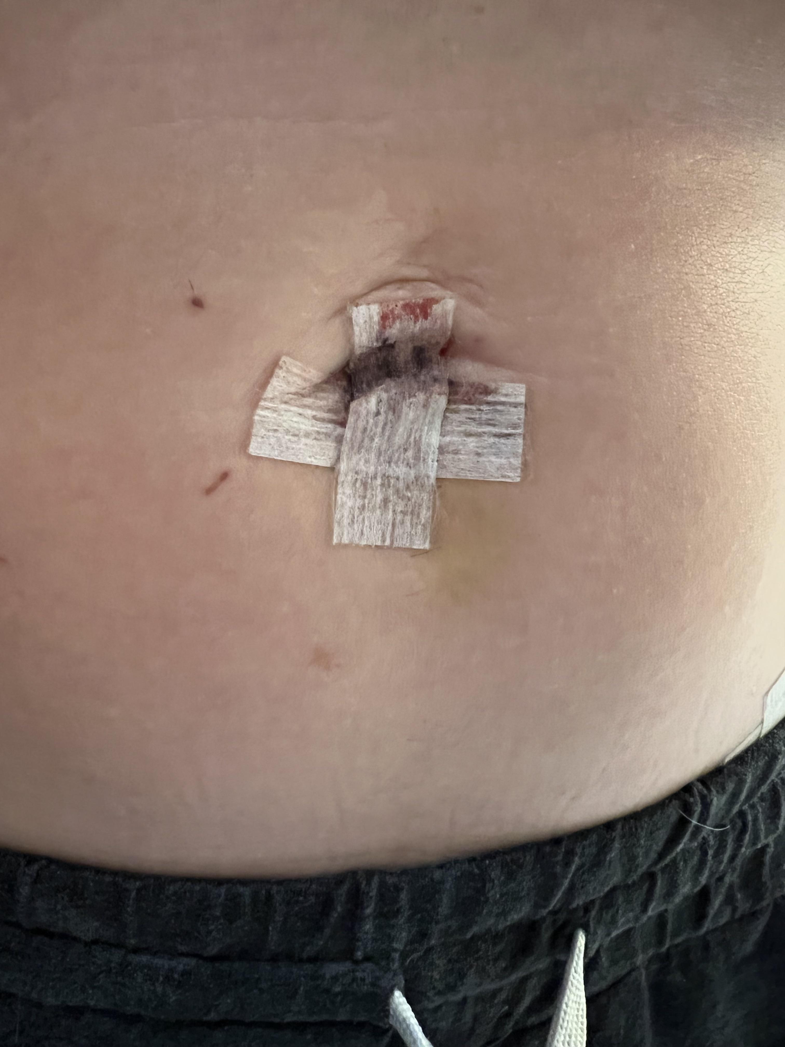 6 days post op hysterectomy done laparoscopically. I’m wondering if