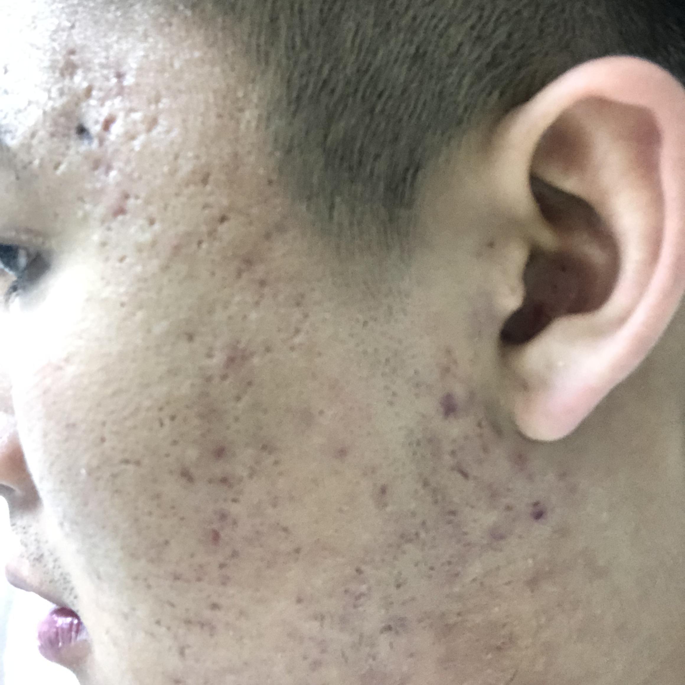 [Acne] Can someone explain what the problem is with my face and how to