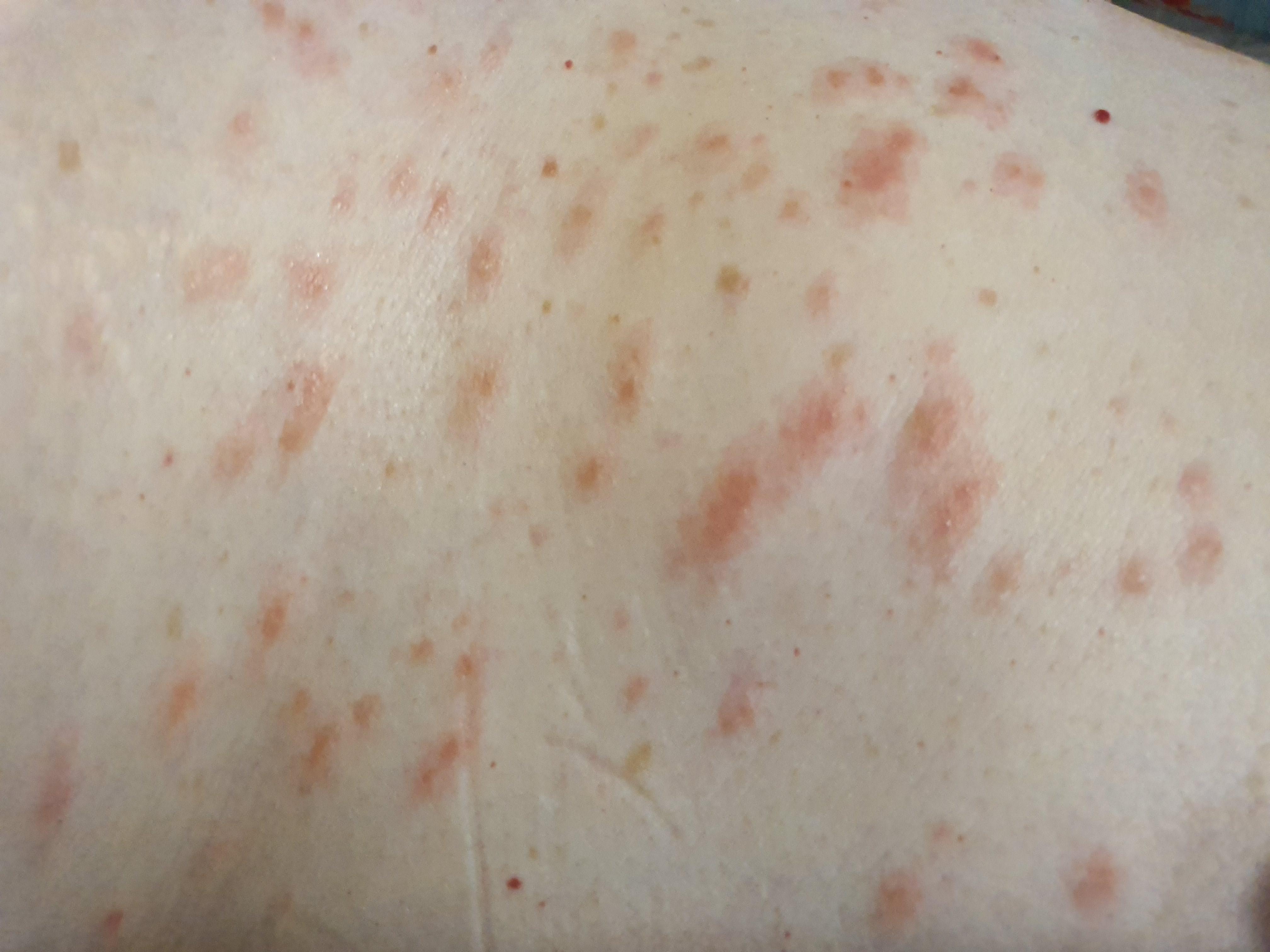 My wife's skin ( mostly breasts and under breasts ) got filled with
