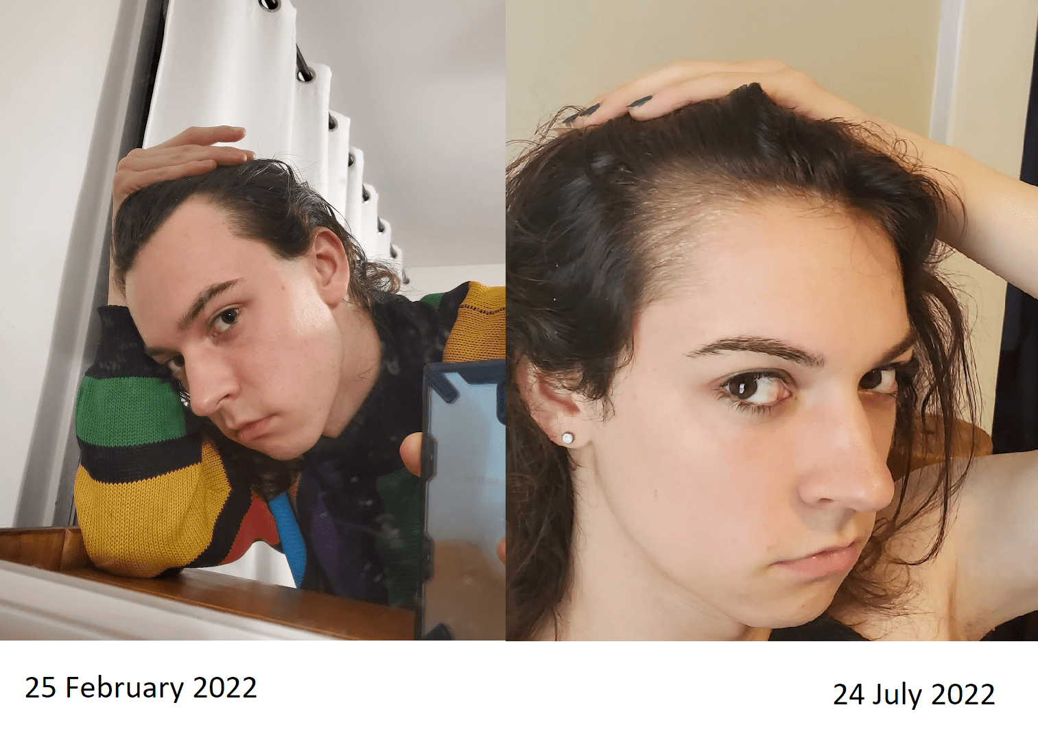 MtF Hairline regrowth with 5.5 months Minoxodil, 5 months Finasteride