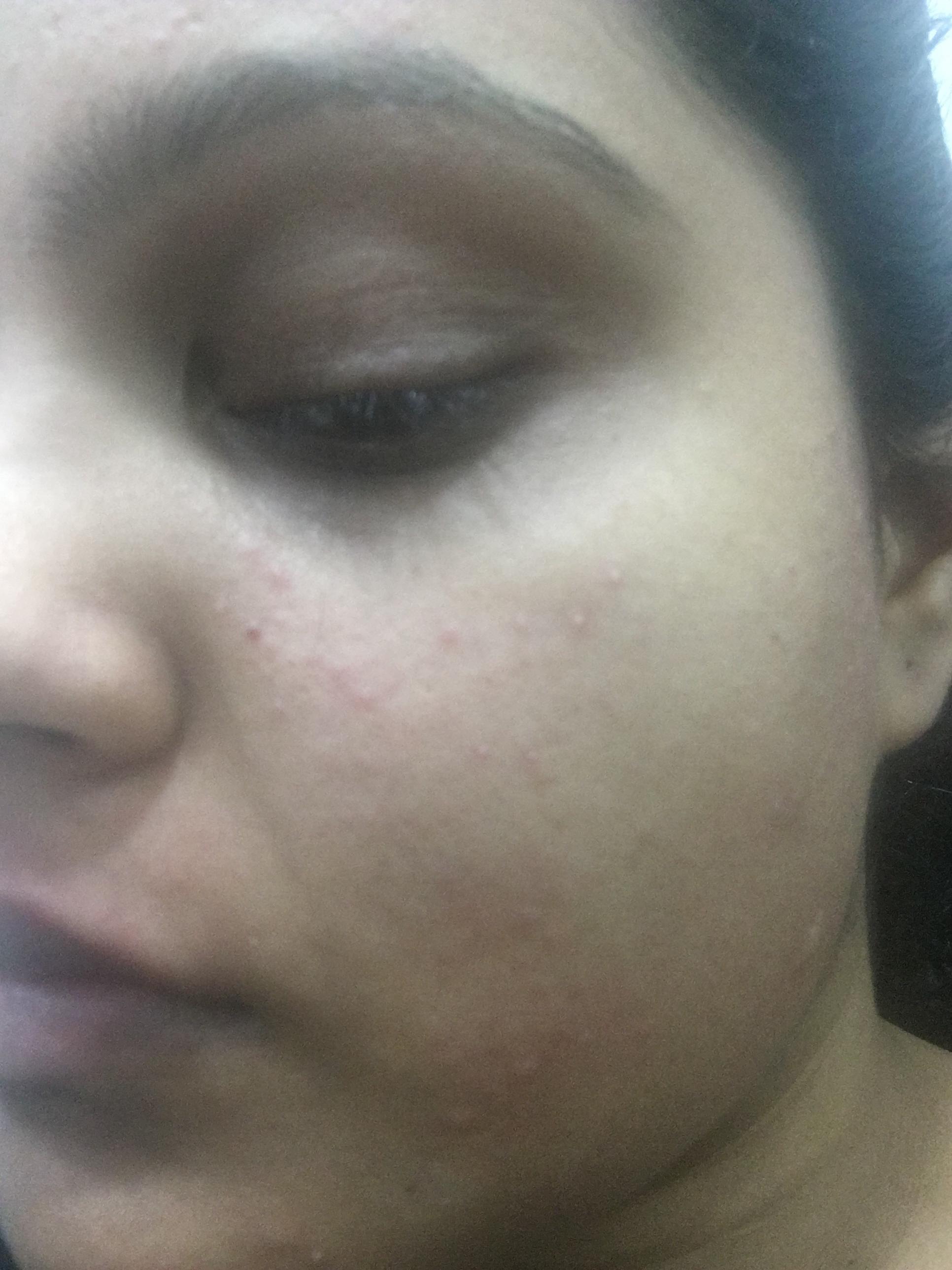 [Hair Removal] I broke out after waxing my sideburns at my local beauty