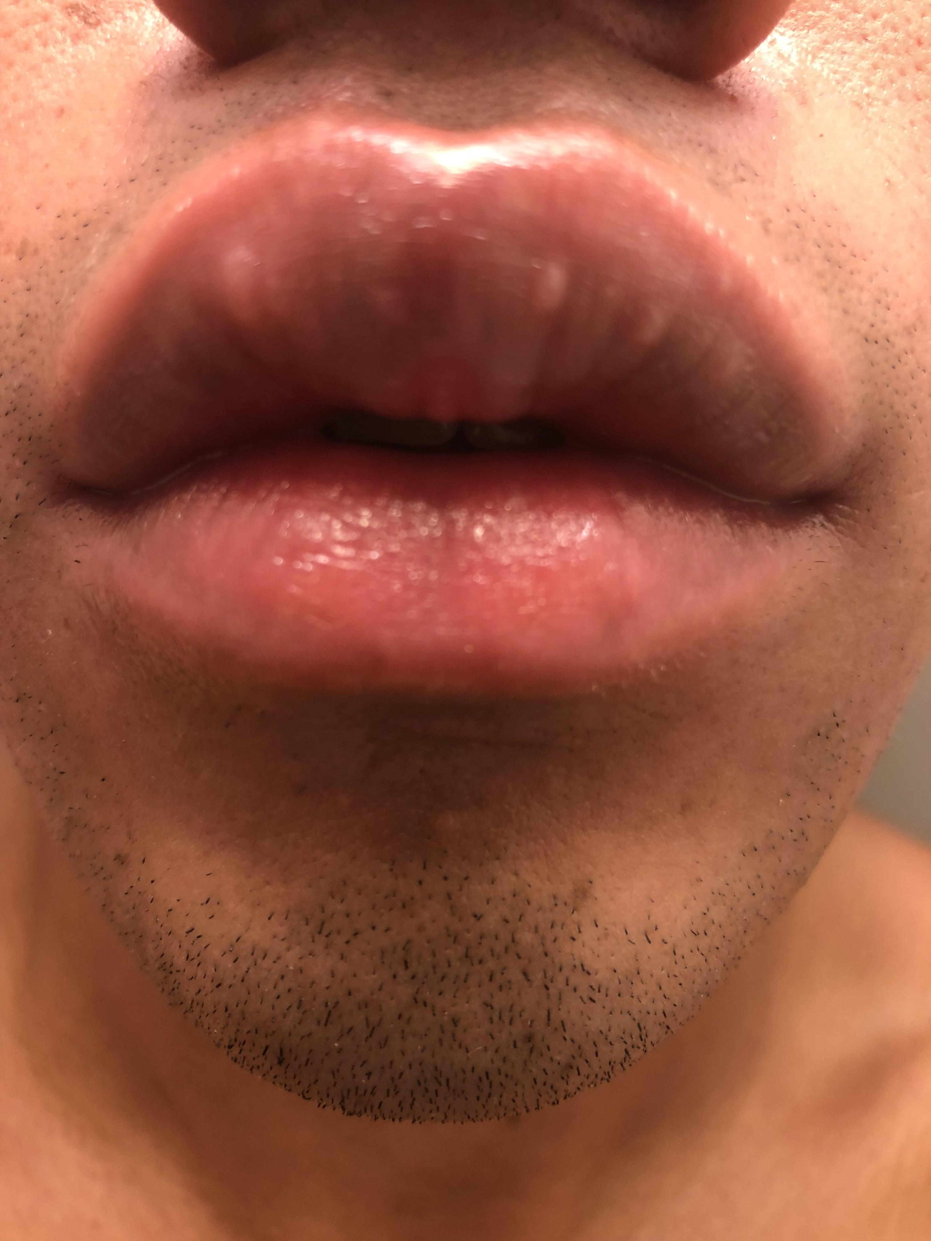 fordyce spots or? Dermatology