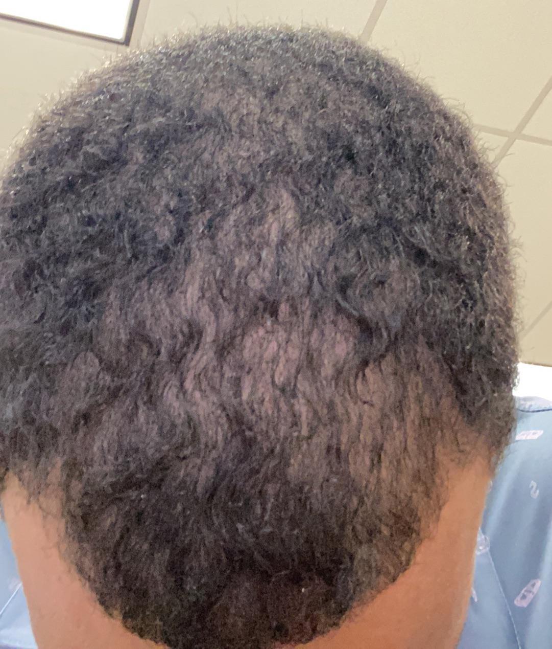 Should I give minoxidil a try? Im afraid it will have bad side effect