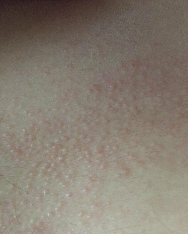 Itchy bumps on chest, abdomen, back of neck, and lower back. Someone please help. r/Dermatology