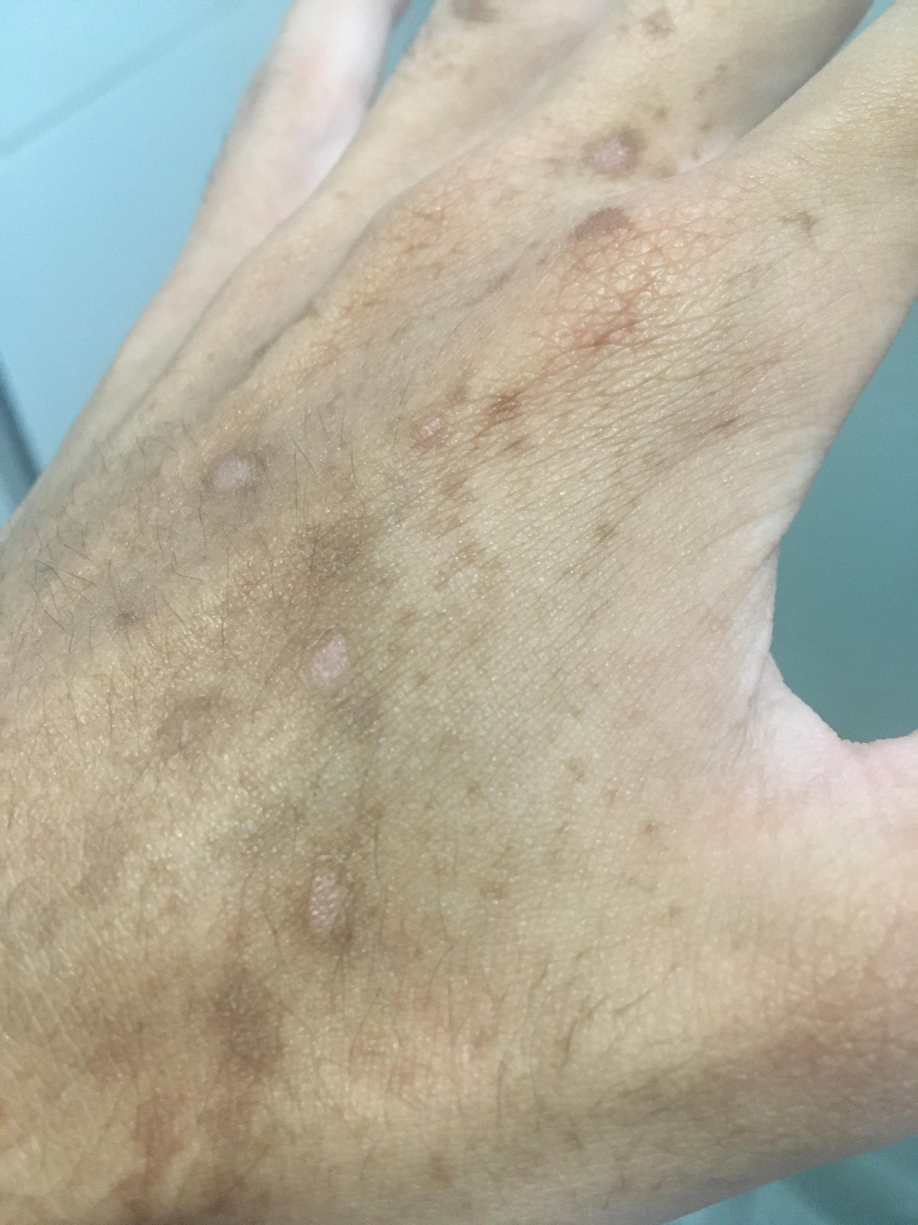 M/20 brown spots appeared only on my left hand overnight , then white dots appeared after a