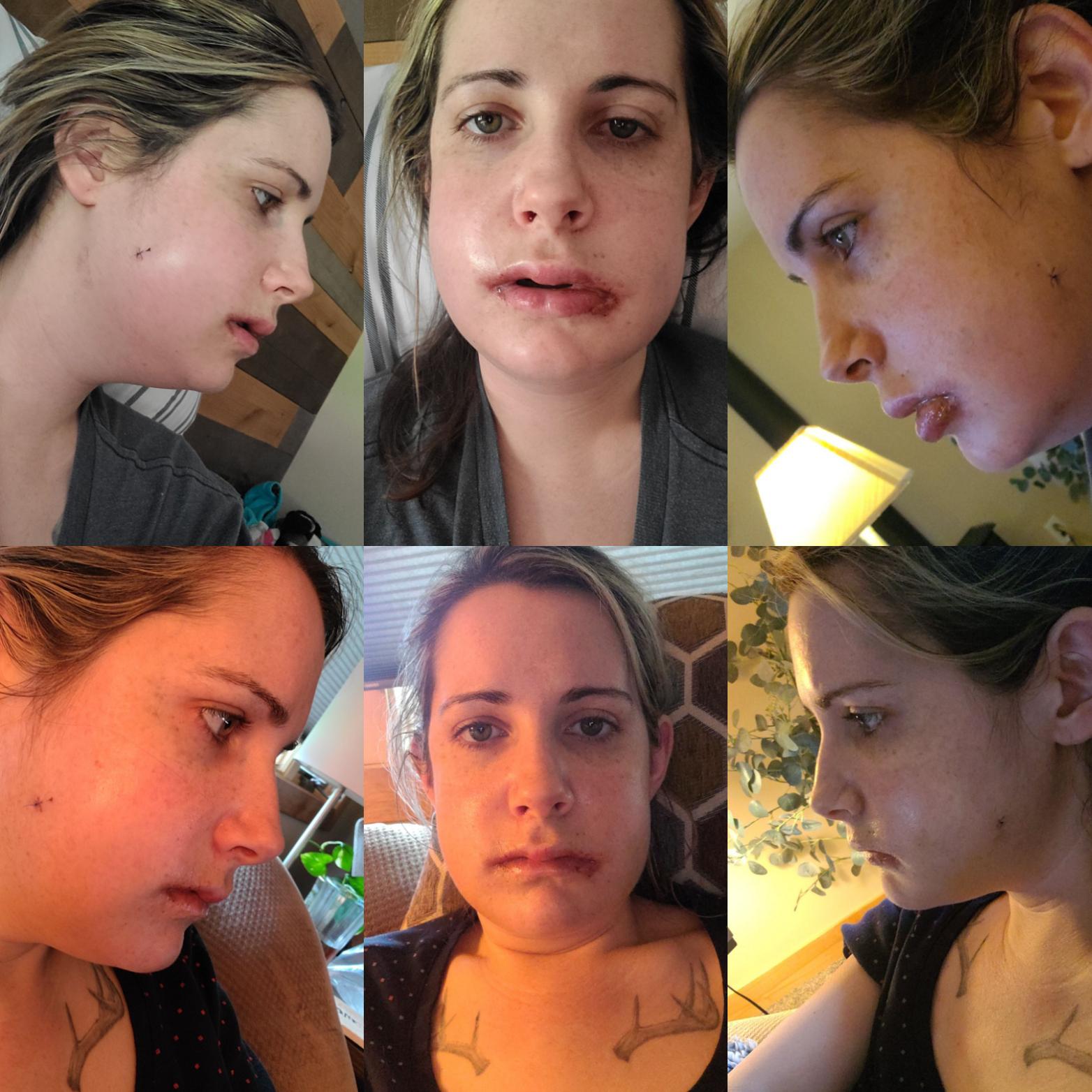 From Day 2 to Day 5! The only pain I feel currently is in my sinuses