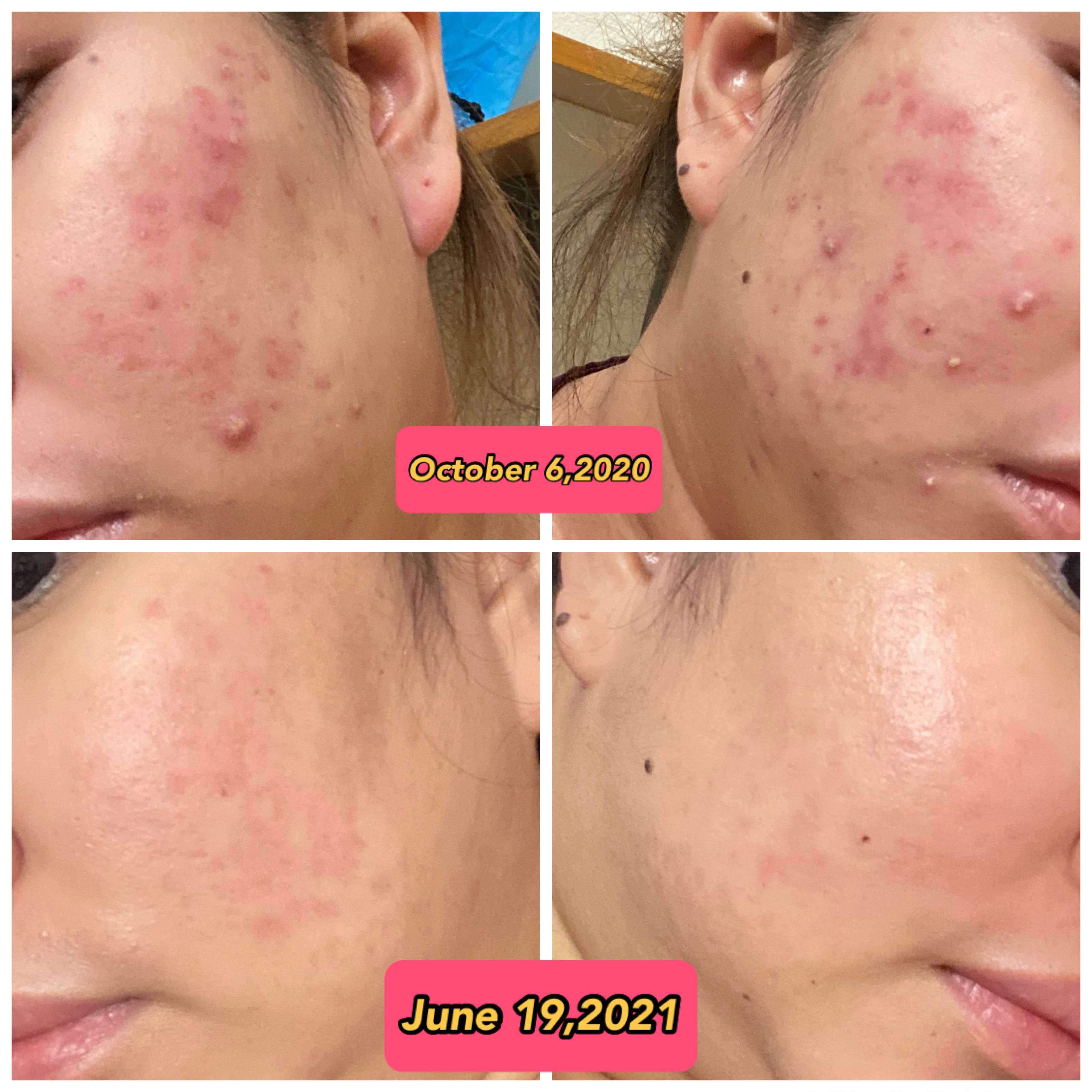 After 8 months of suffering from the side effects, (joint pain and