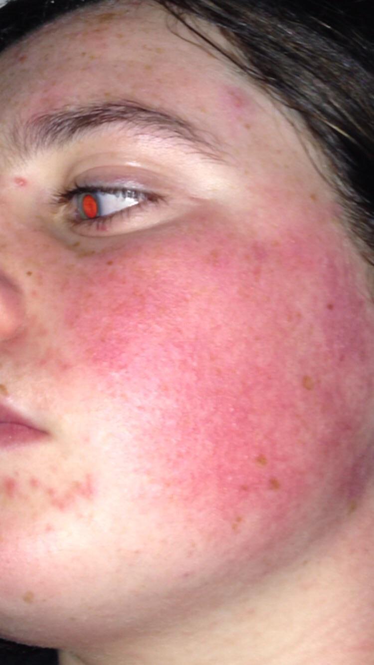 Hi I think I might have the starting of rosacea. I am 15 years old and