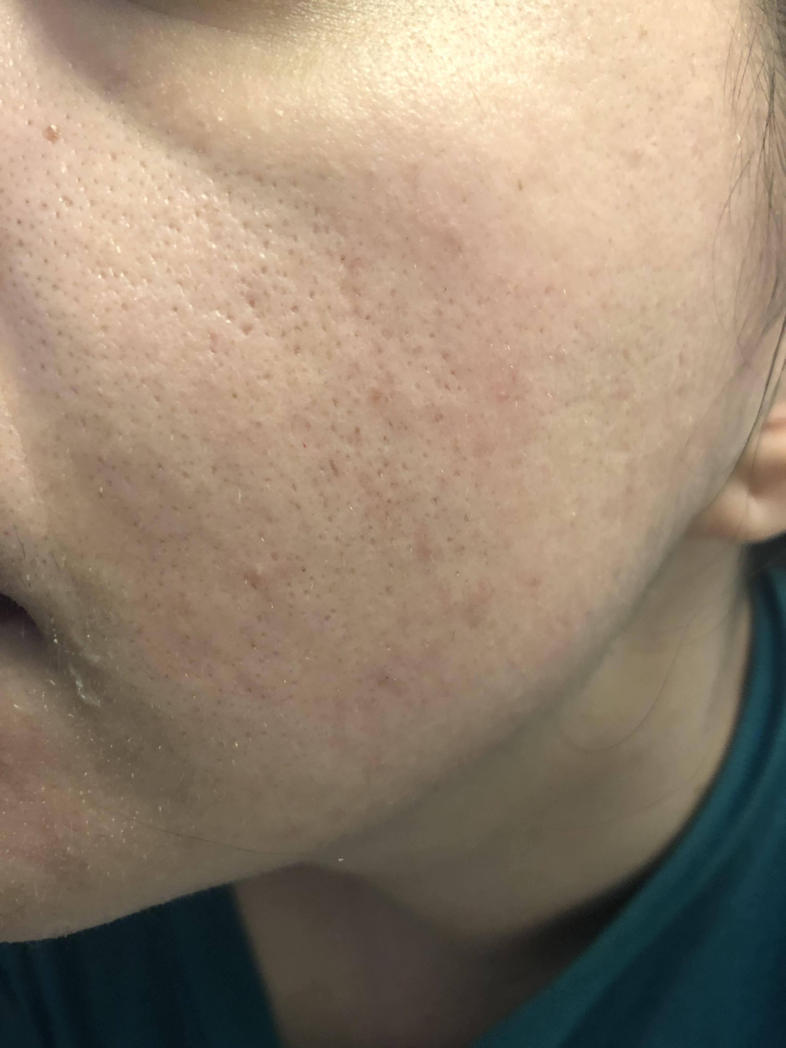 [Acne] My skin always looks better in the morning and this is as good