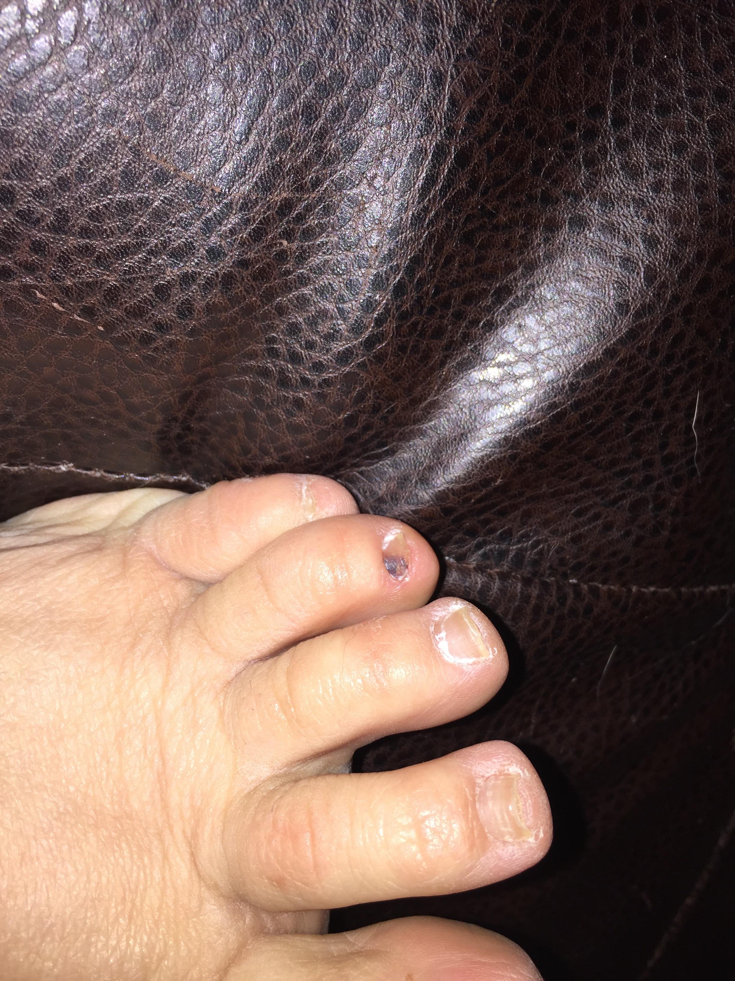 melanoma vs bruise bruise under toenail vs melanoma Swhshish