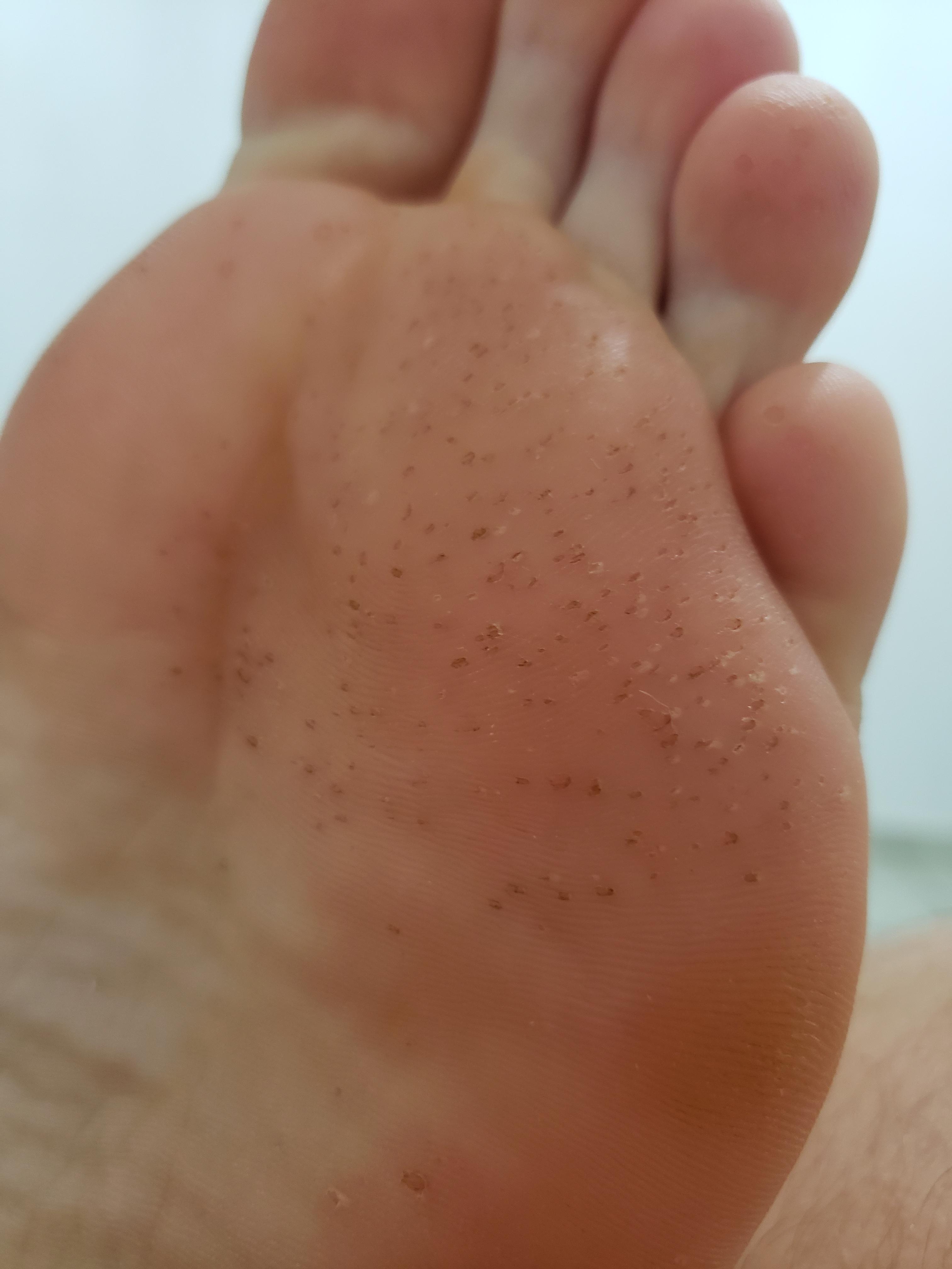 Help! This is on my husband's feet. Pitted keratolysis? r