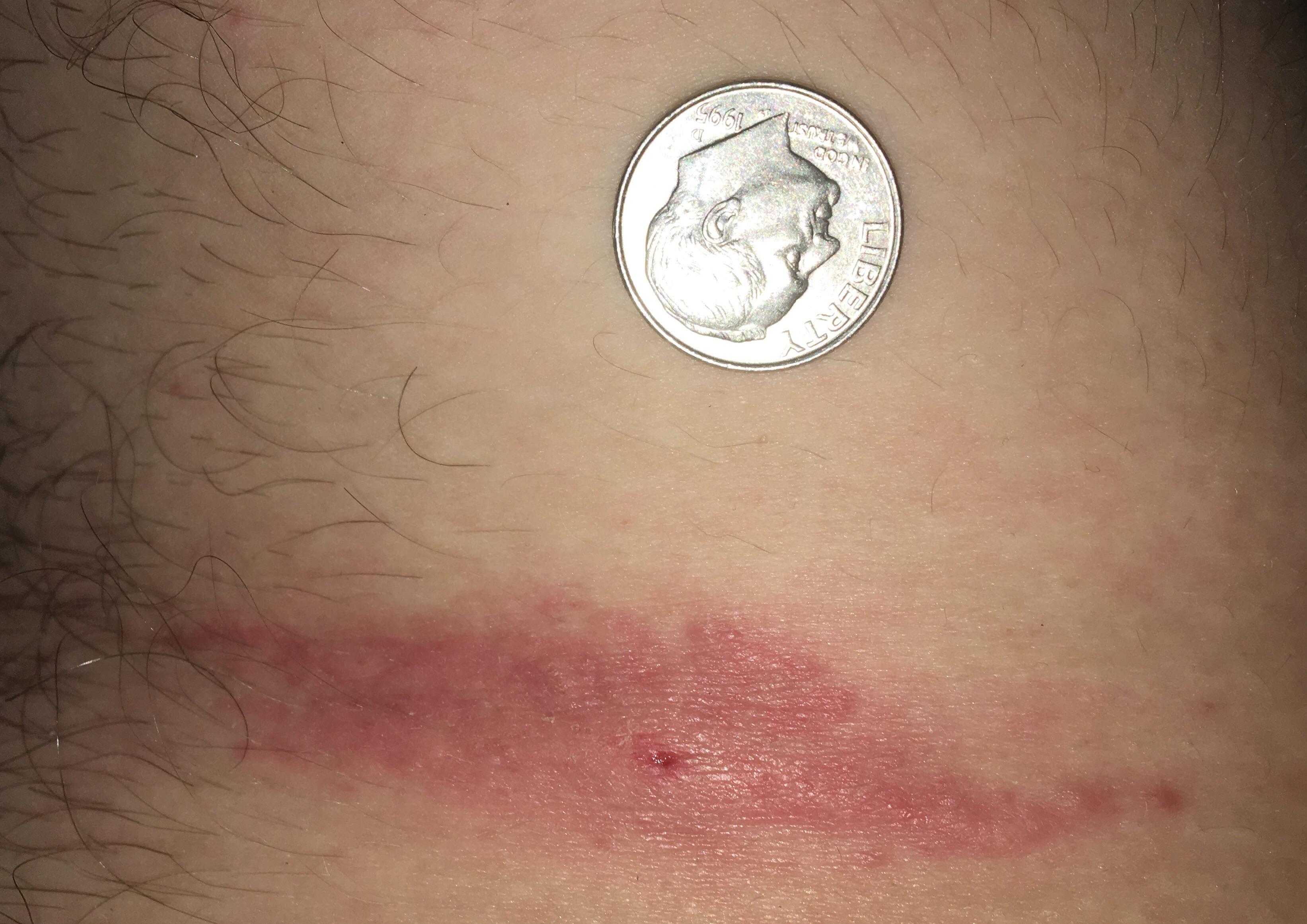 Symptoms of Tickborne Illness Ticks CDC