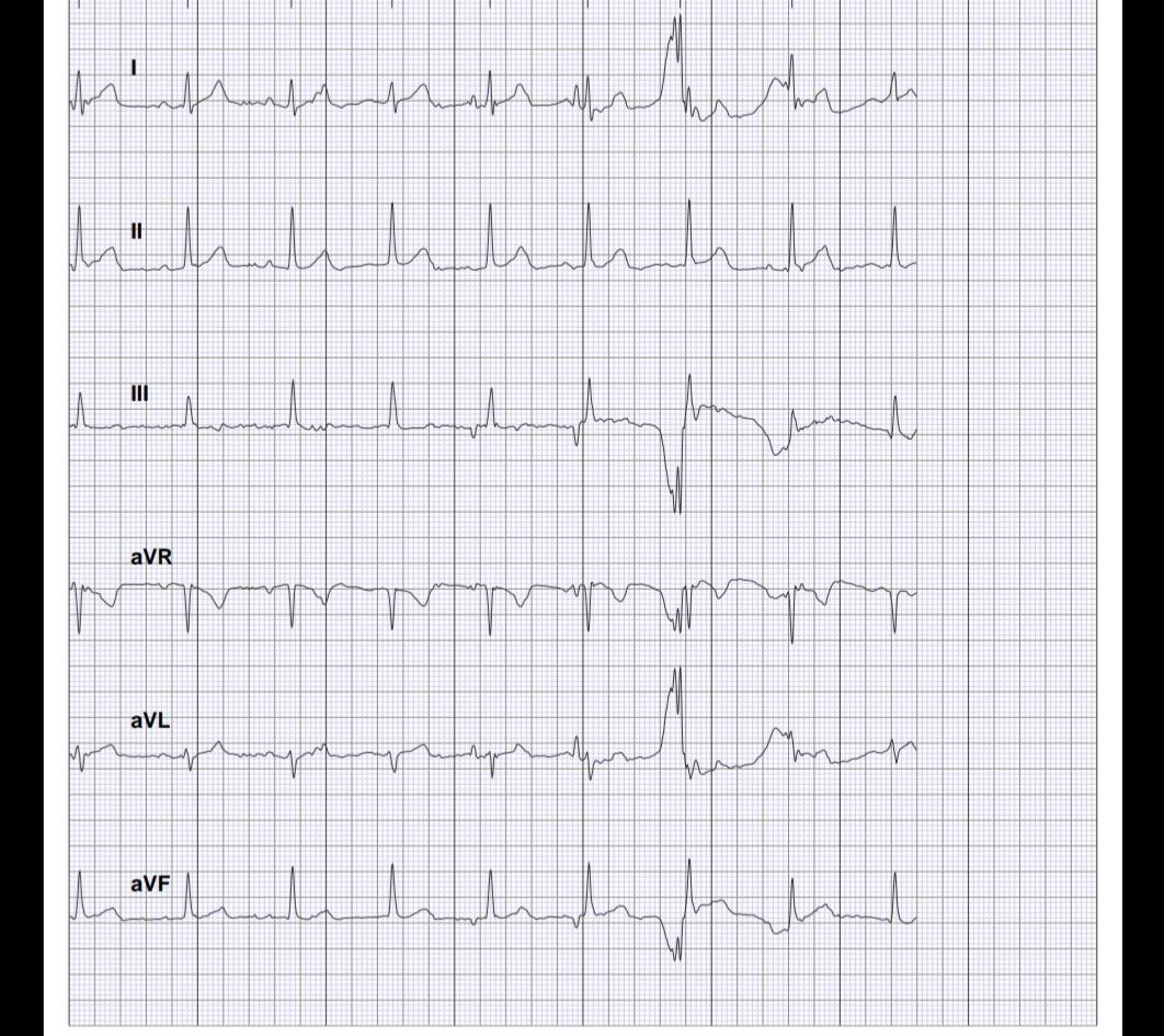 PVC on Kardia? r/ReadMyECG