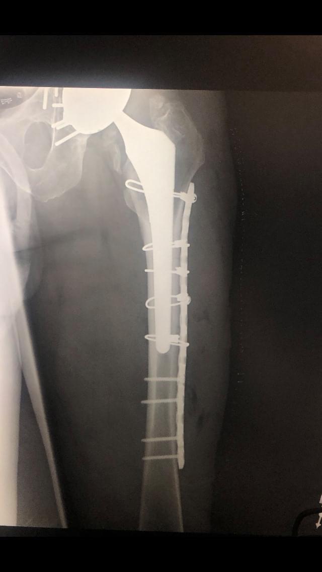 My brother had a spiral fracture of his femur 2 days ago, after his