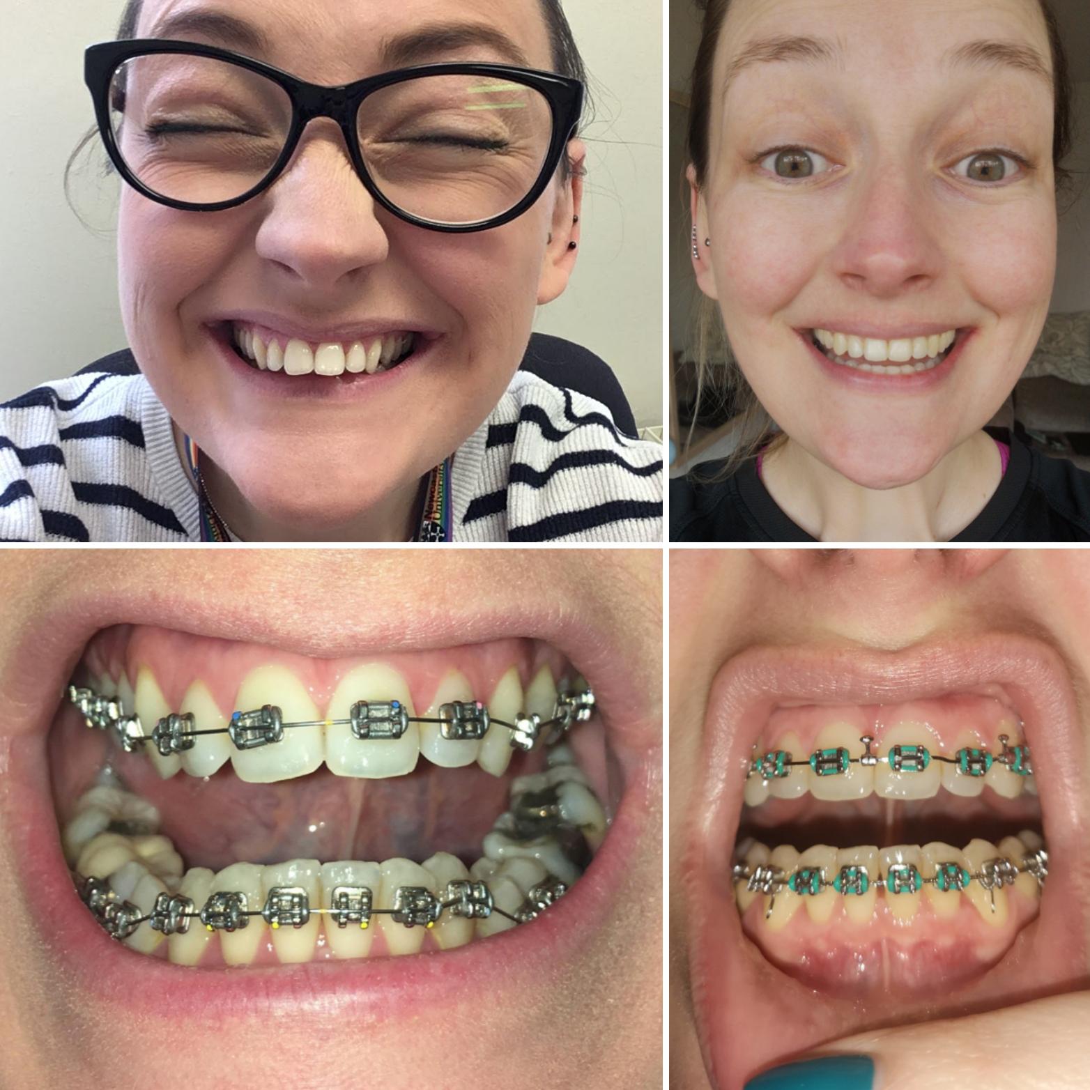 Braces came off today. Left is the day I got them on (Nov 2019). Right