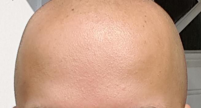 [Skin concerns] How to tackle rough, bumpy skin? Not acne