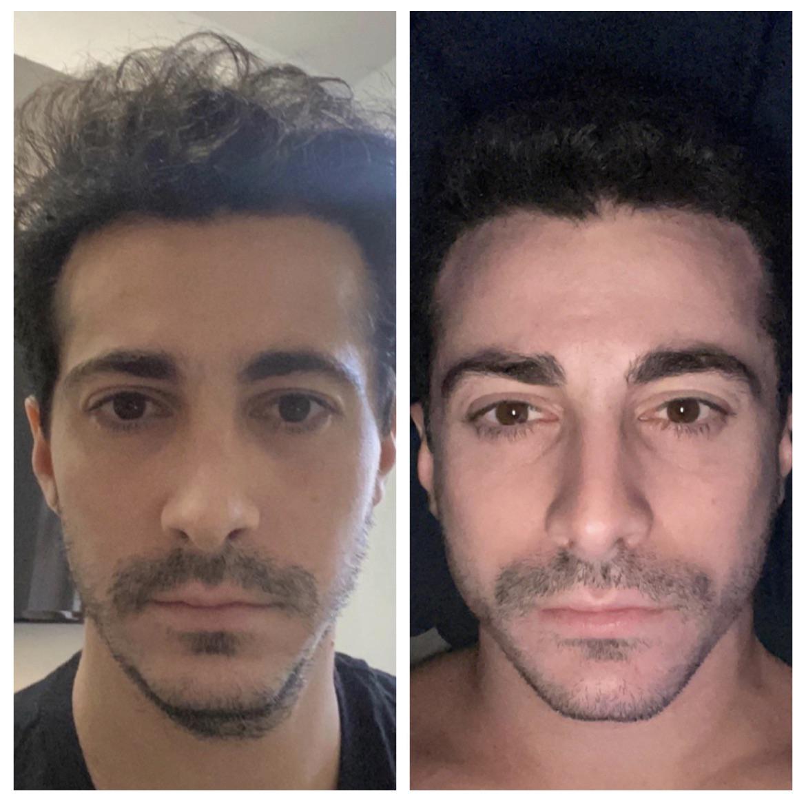 30 y/o 2 months of CHEWING falim! r/Mewing