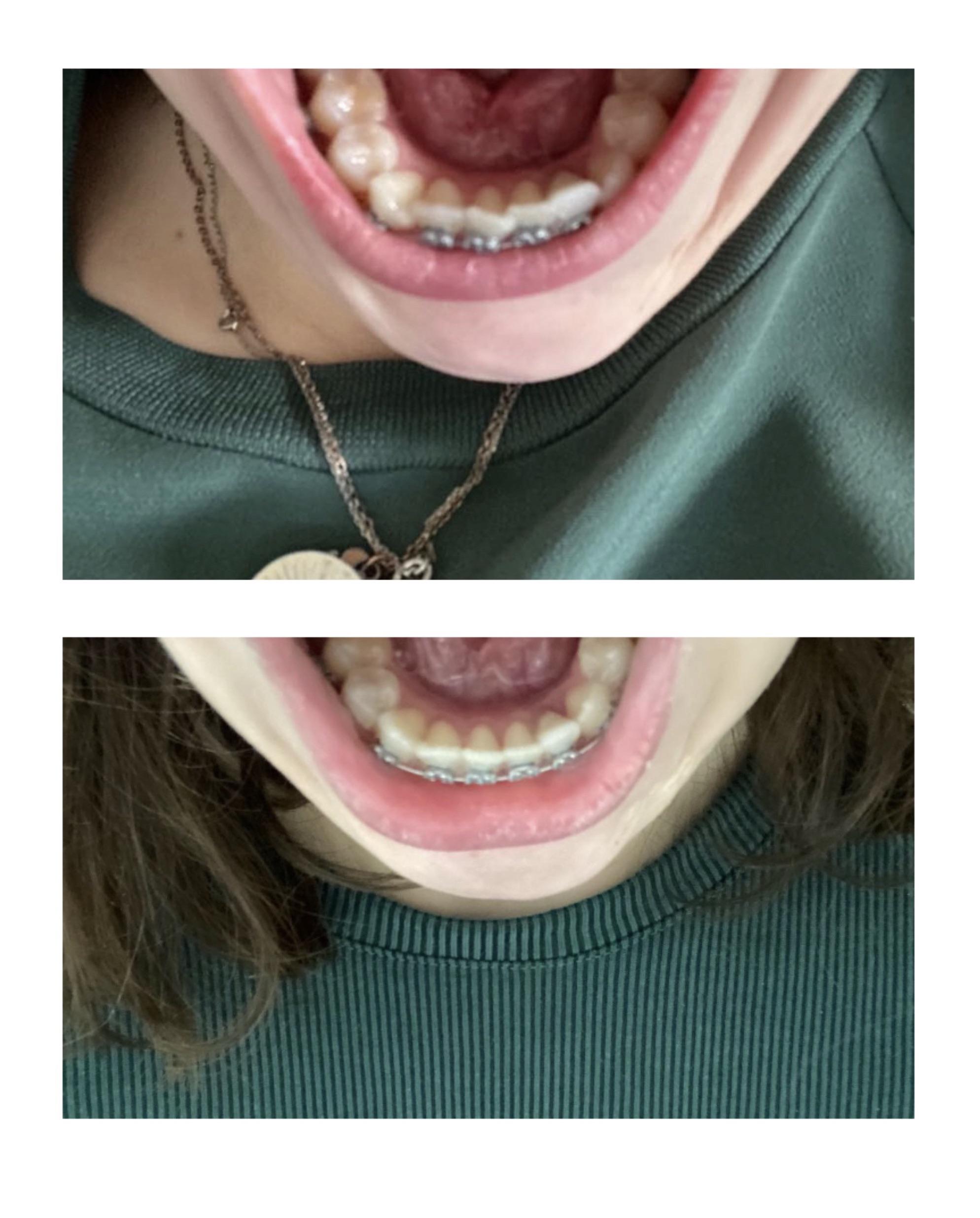 Day 7 and day 42 of adult braces in my very late 20s r/braces