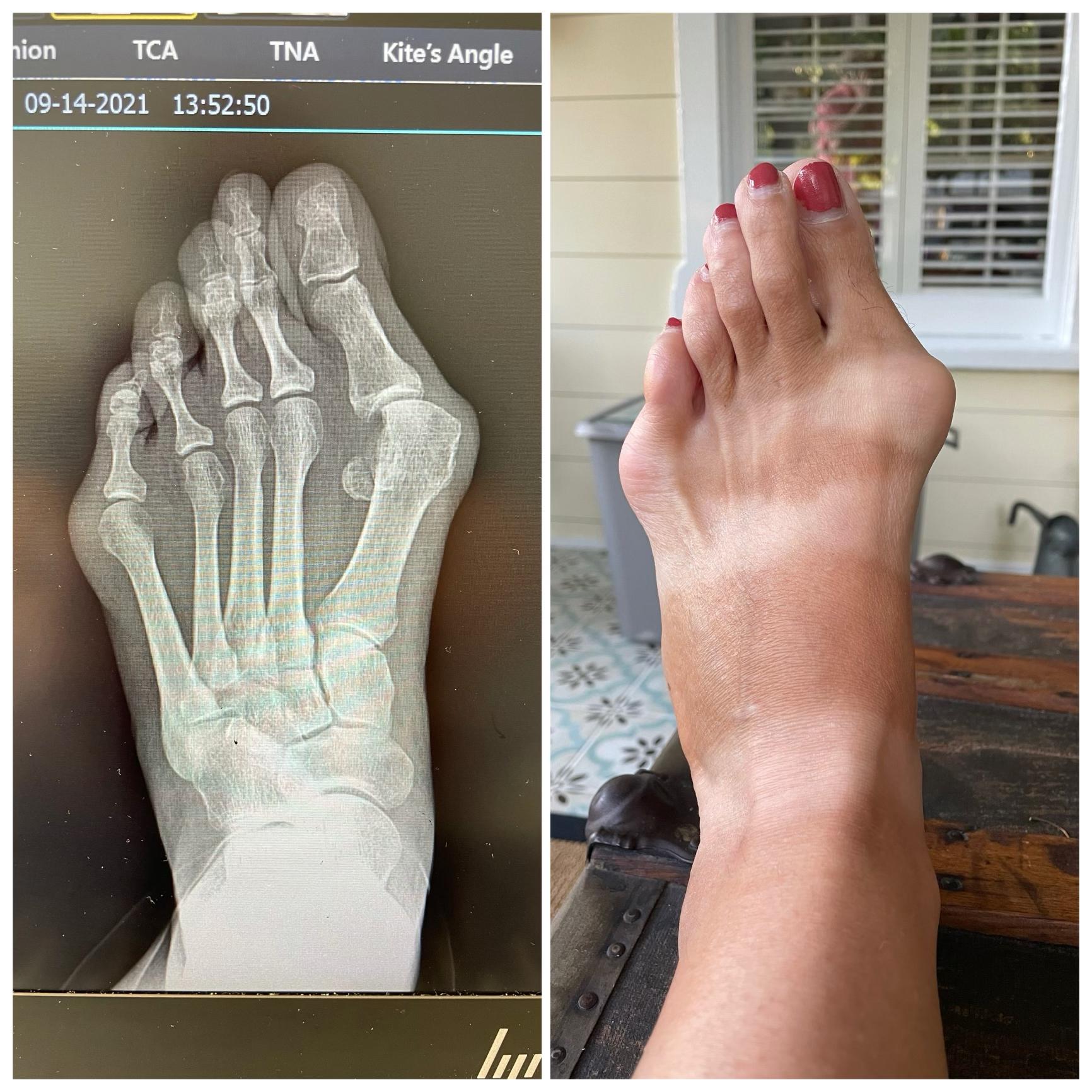 276 best r/bunions images on Pholder Got my cast off after 6 weeks