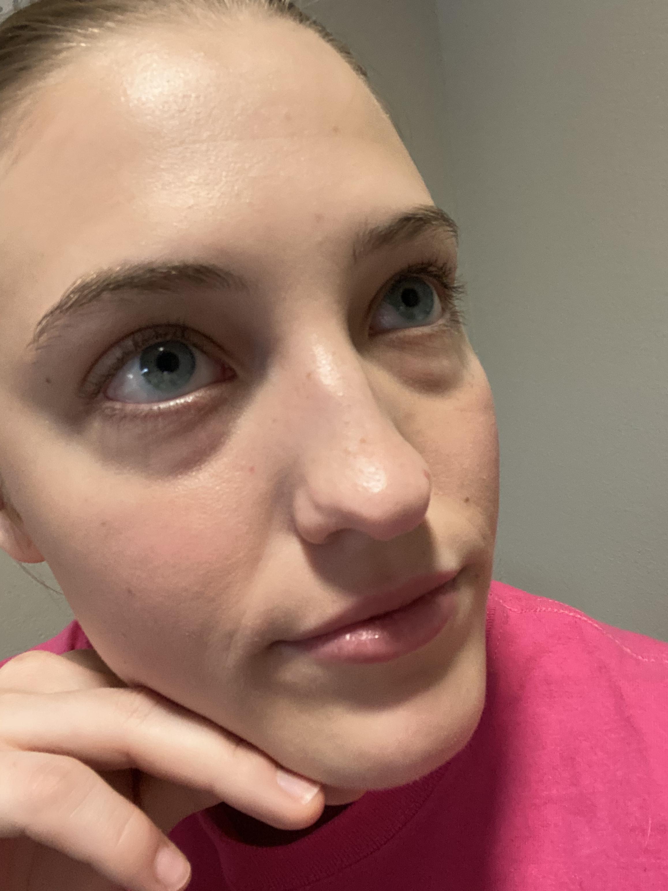 [Skin concern] I have the worst dark circles ever!! Pretty sure they’re