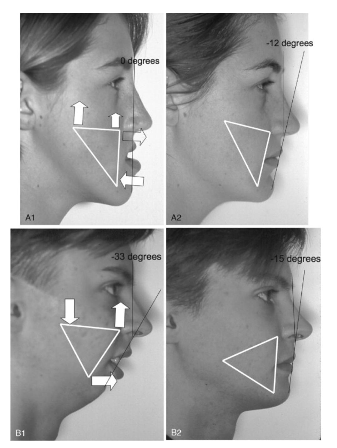 Could someone tell me what's the name of this surgery? Is it double jaw