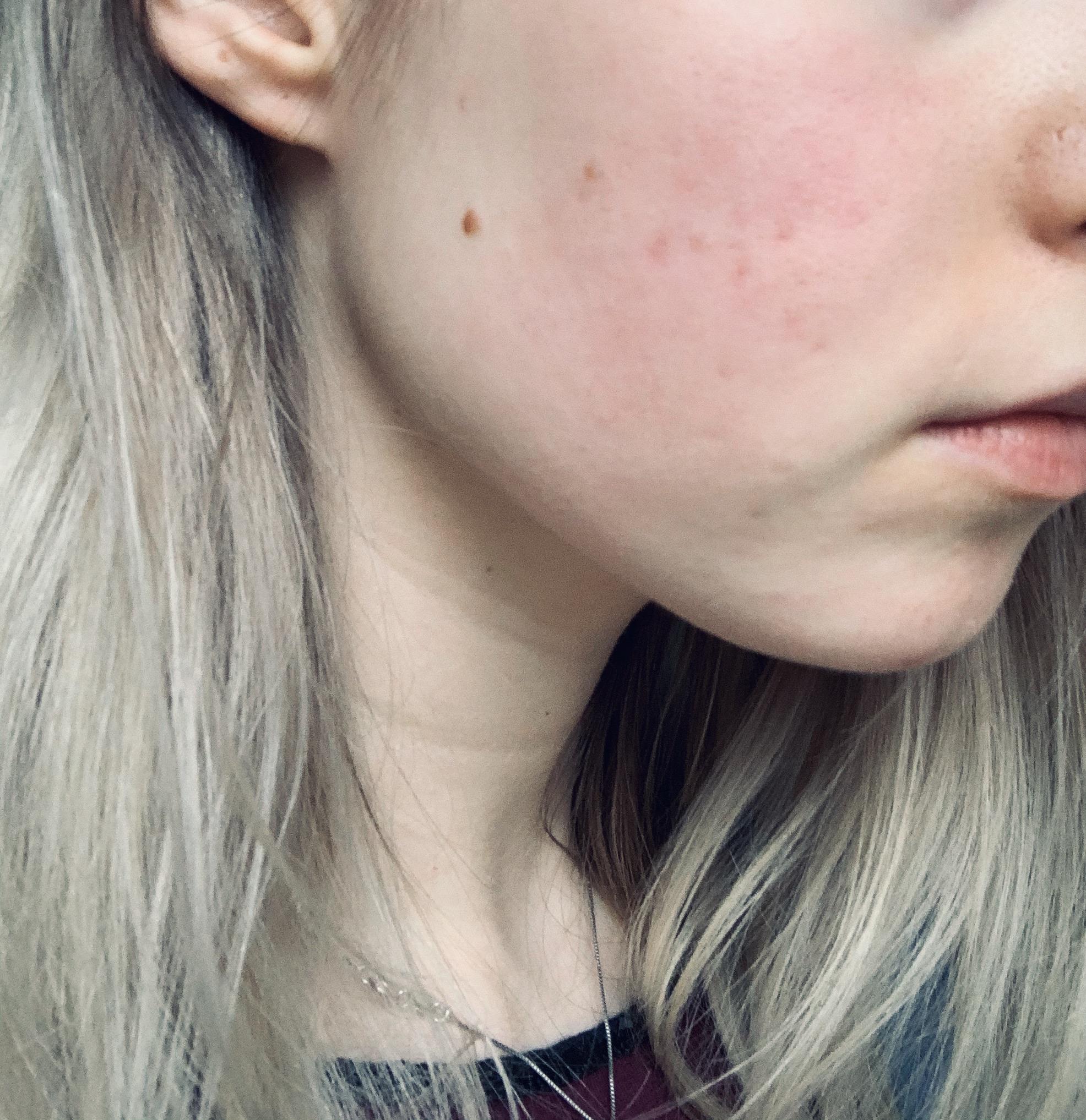 [skin concerns] My skin has improved a lot, but I still have these