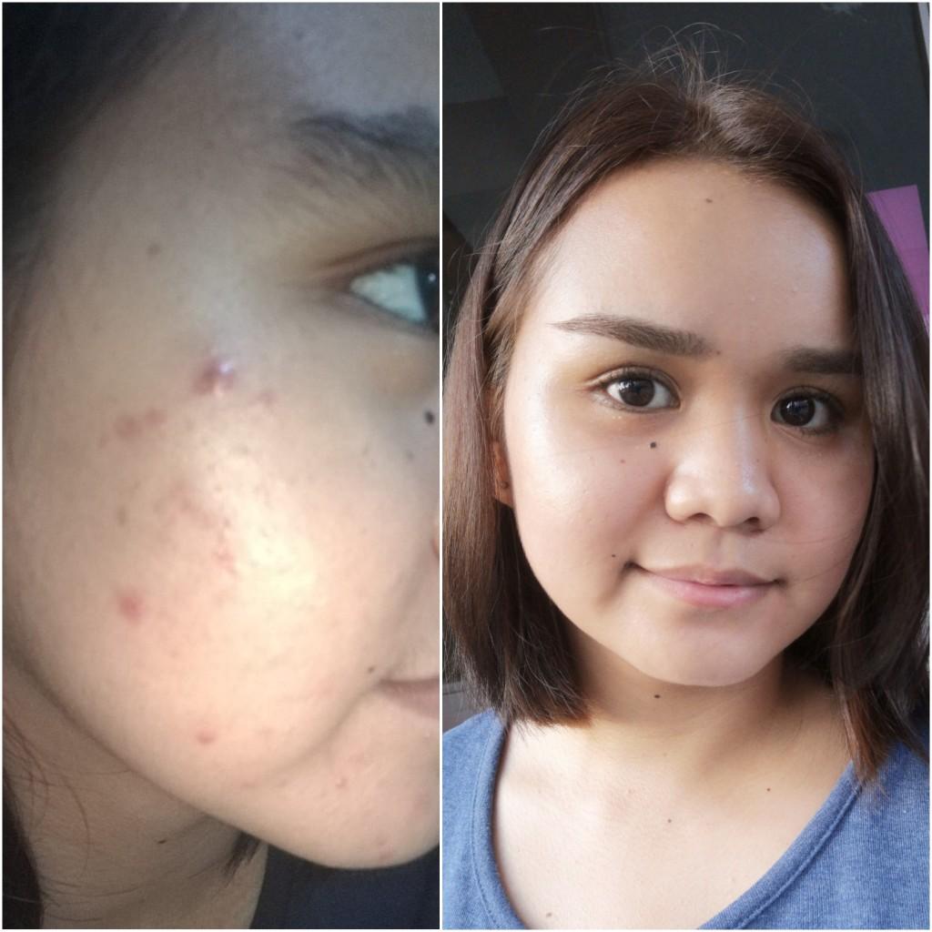 [B&A] After years of struggling with acne, this is now how my skin
