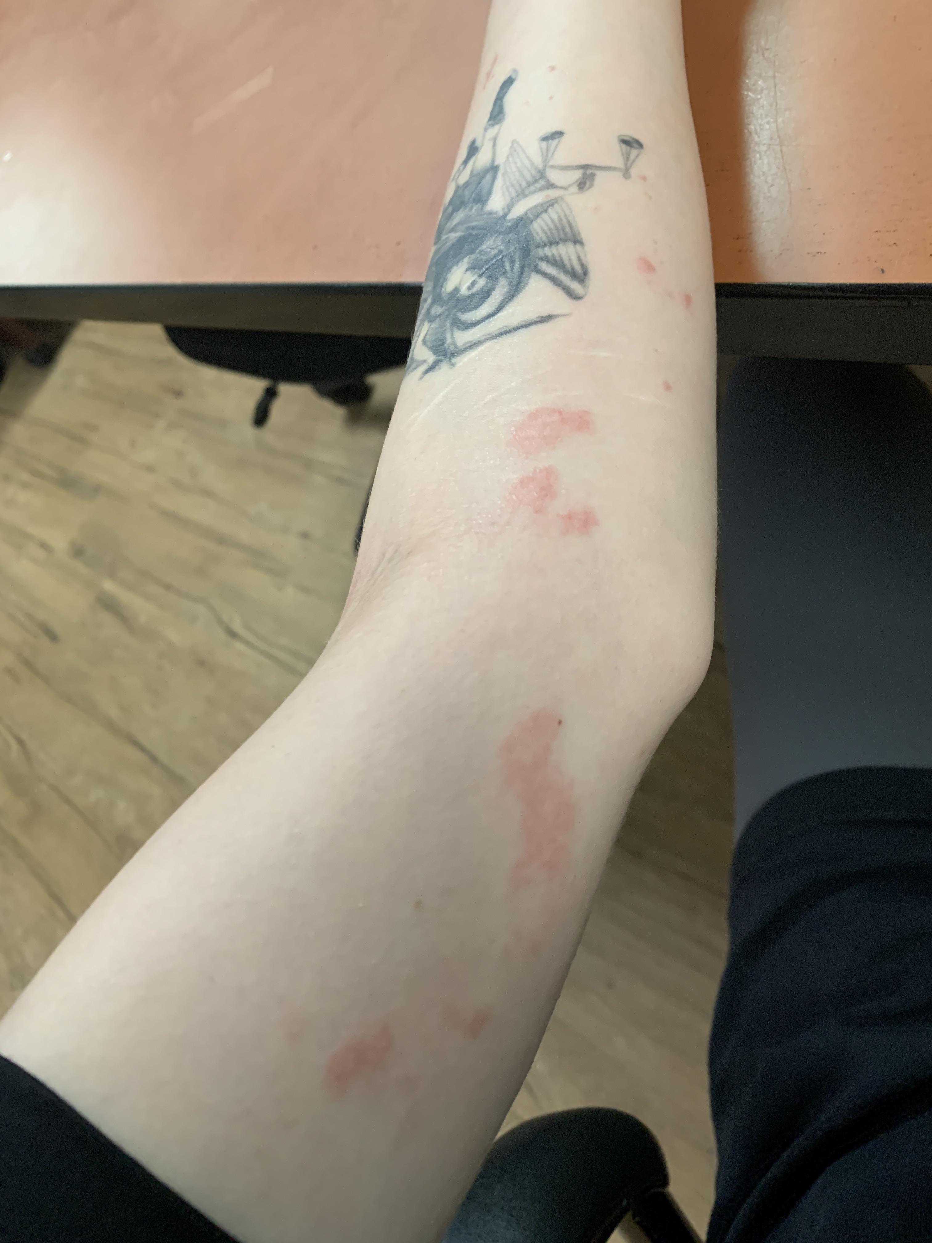 Lotion for eczema from accutane?!?? r/Accutane