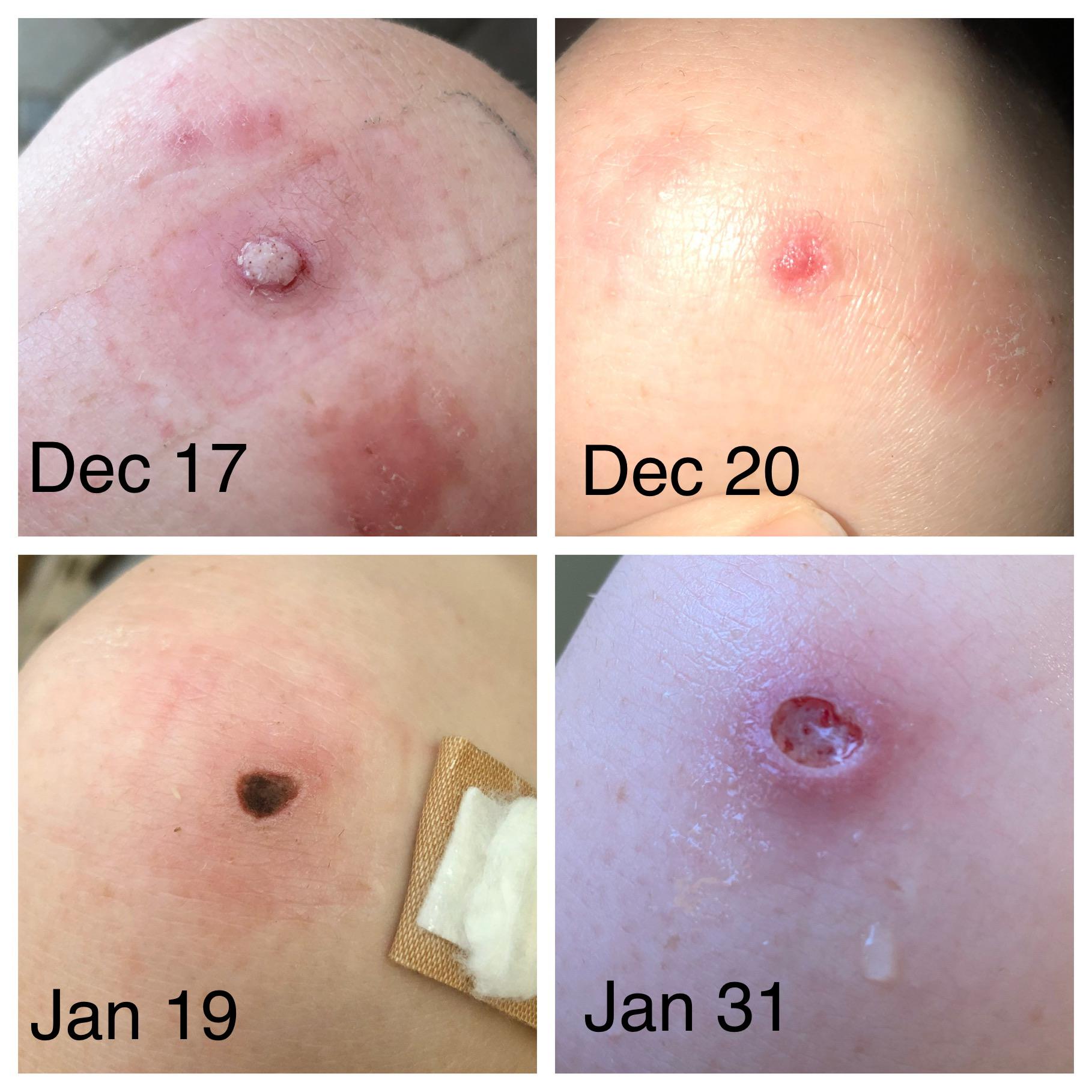 Knee wart progress! Did SA for EVER and it didn’t work