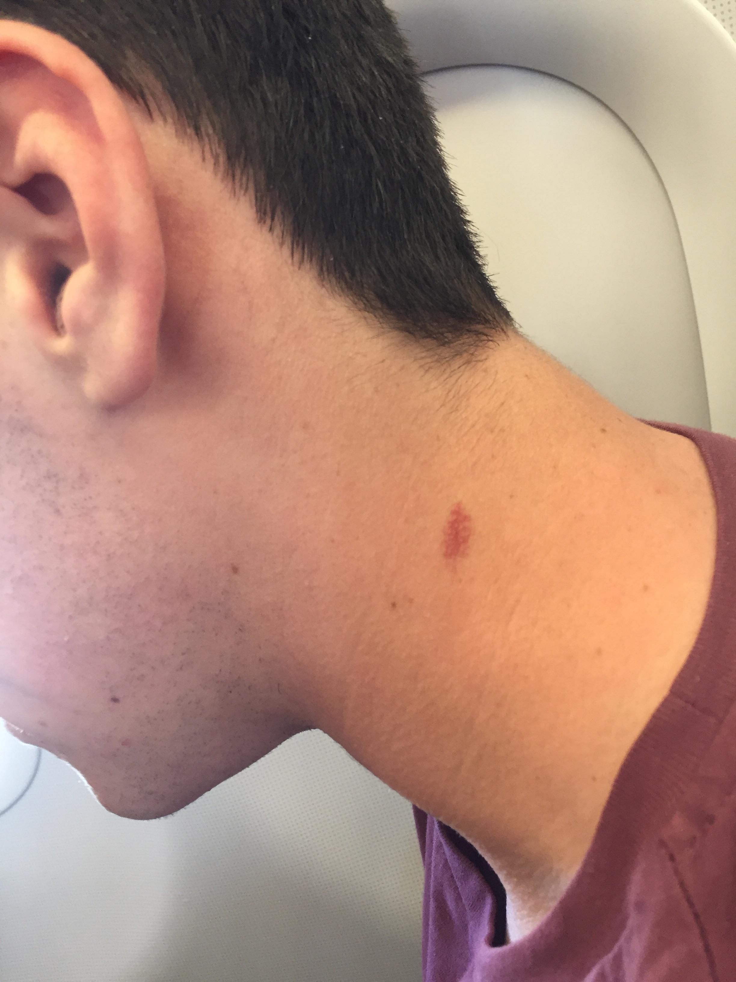 This weird birthmark which looks strangely like a hickey/ love bite r