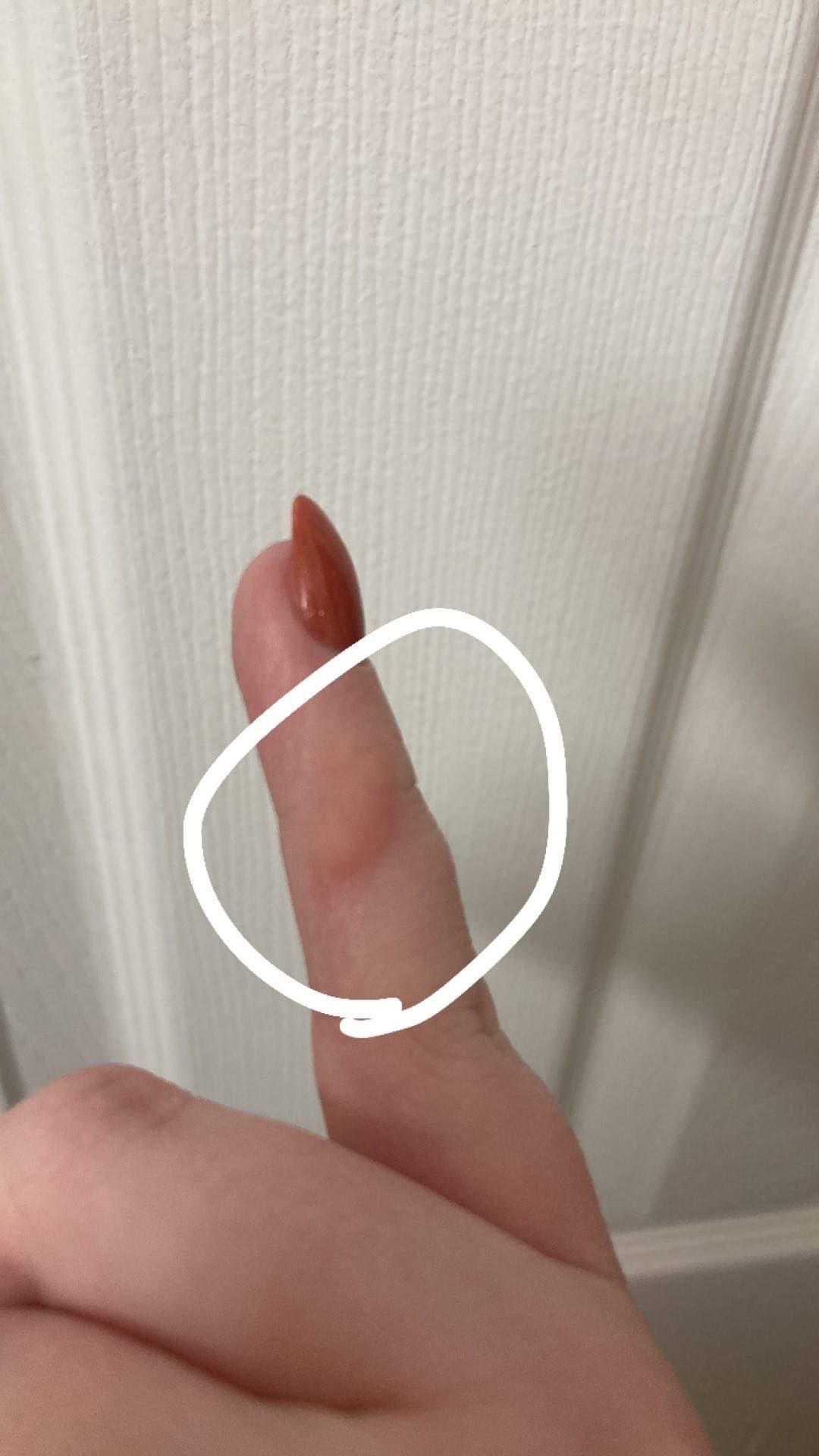 Did my wife just get a chemical burn from acrylic nails? r/Nailpolish