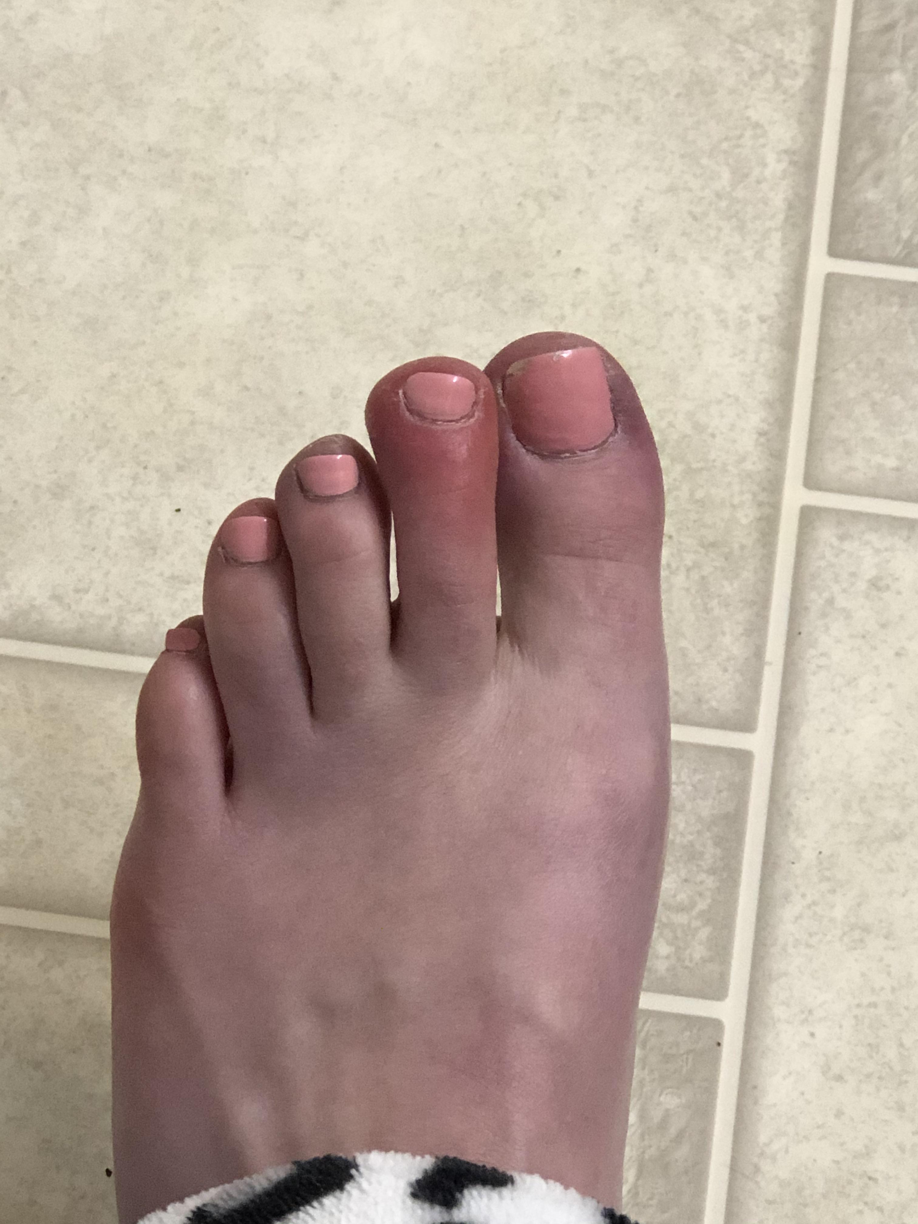 Chilblain?? This happens to my toe all the time! I loose complete