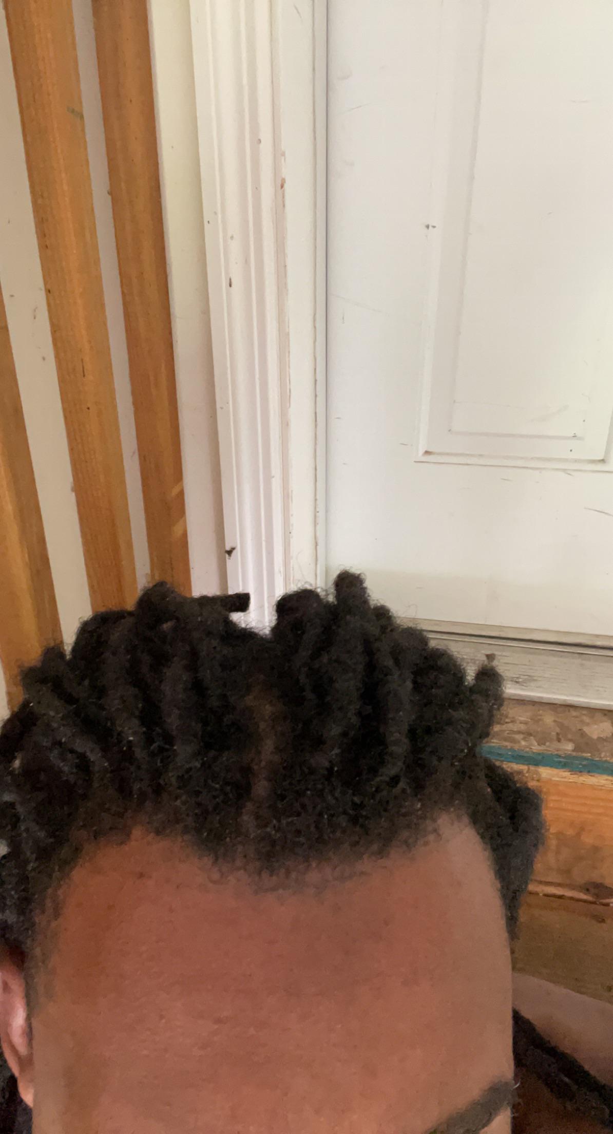 My dreads are on my hairline when I get a ponytail it pulls on it