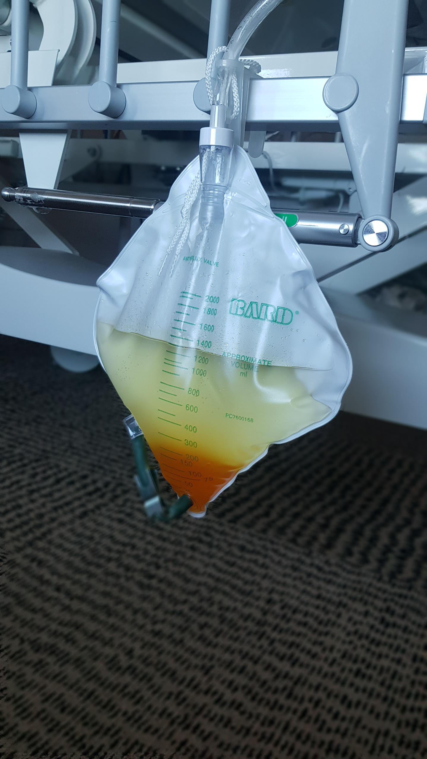 The separation of the urine in my wife's catheter bag after having a C