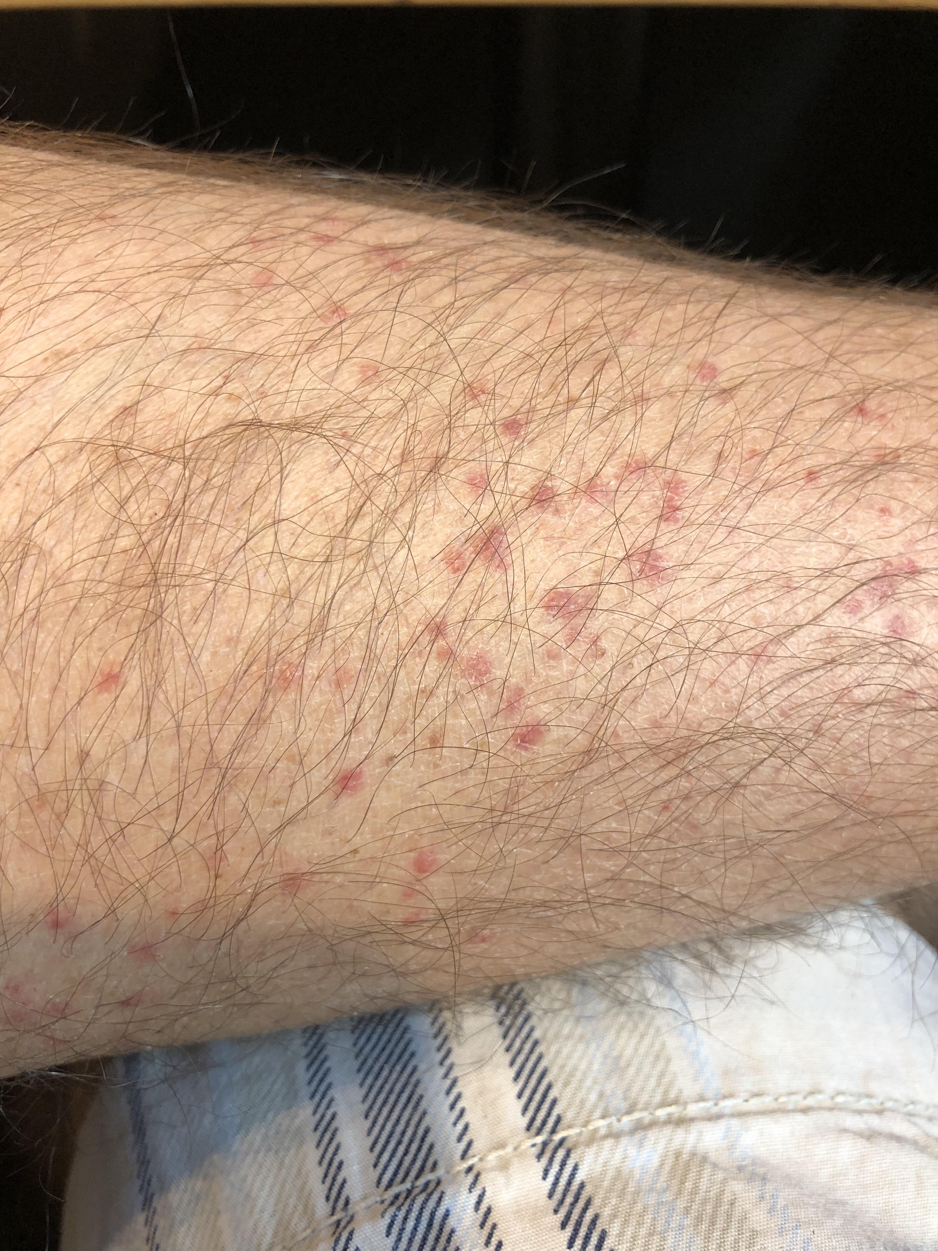 These red spots just started to appear on my lower legs once I got to