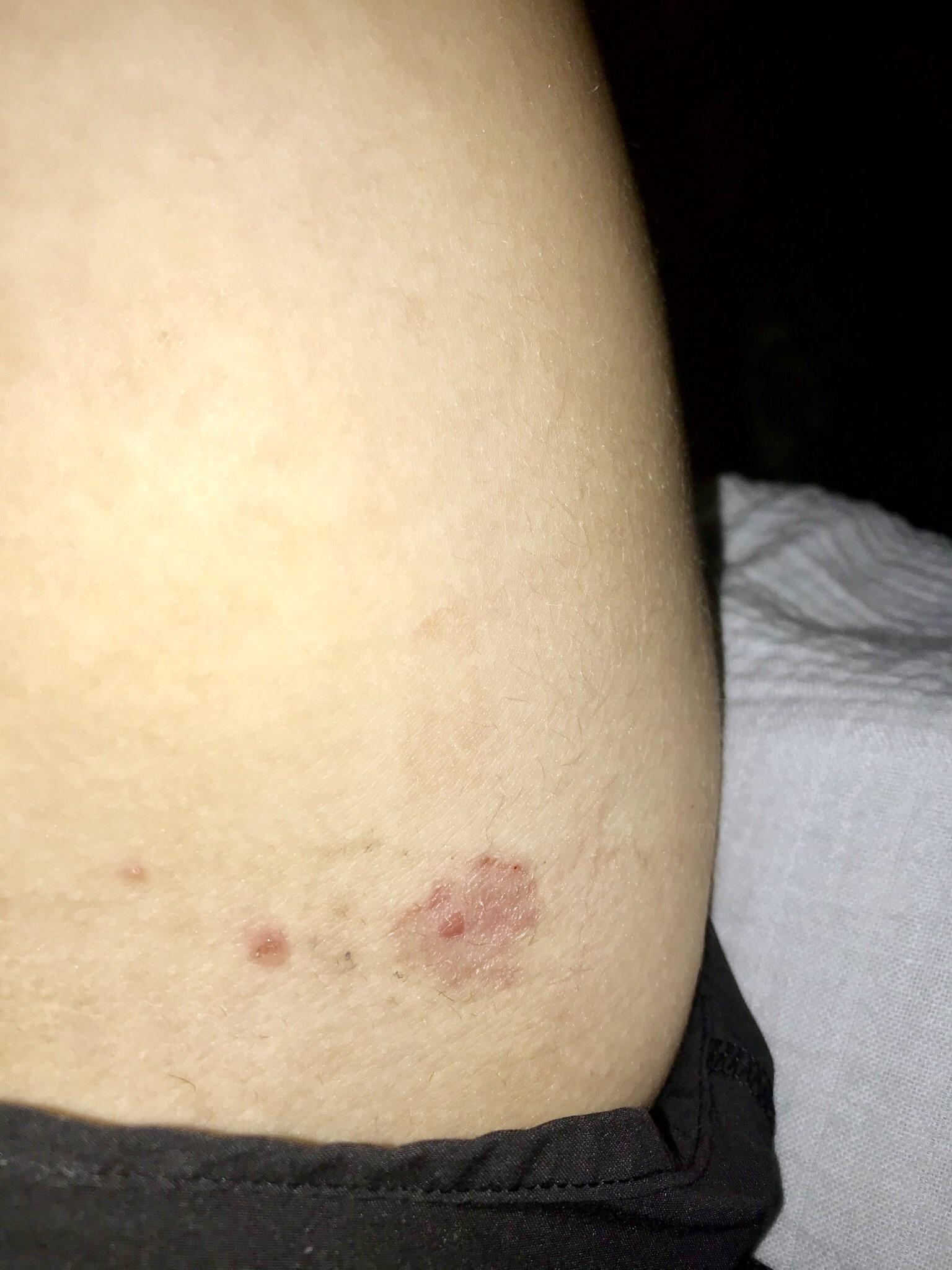 What is this it’s in my inner thigh it started as a blister r/STD