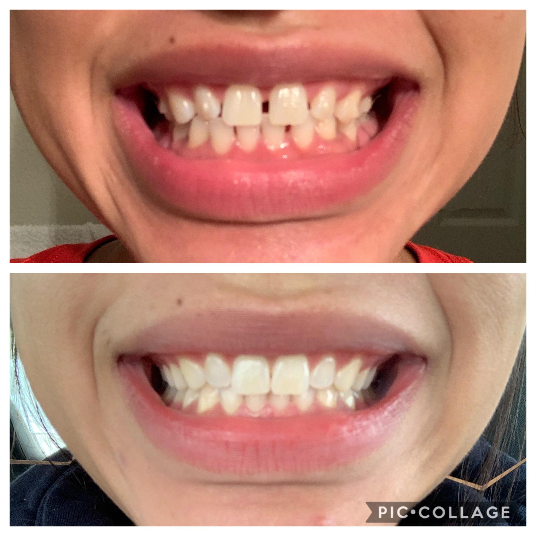 Onto refinements! Tray 1 vs Tray 26 with attachments removed
