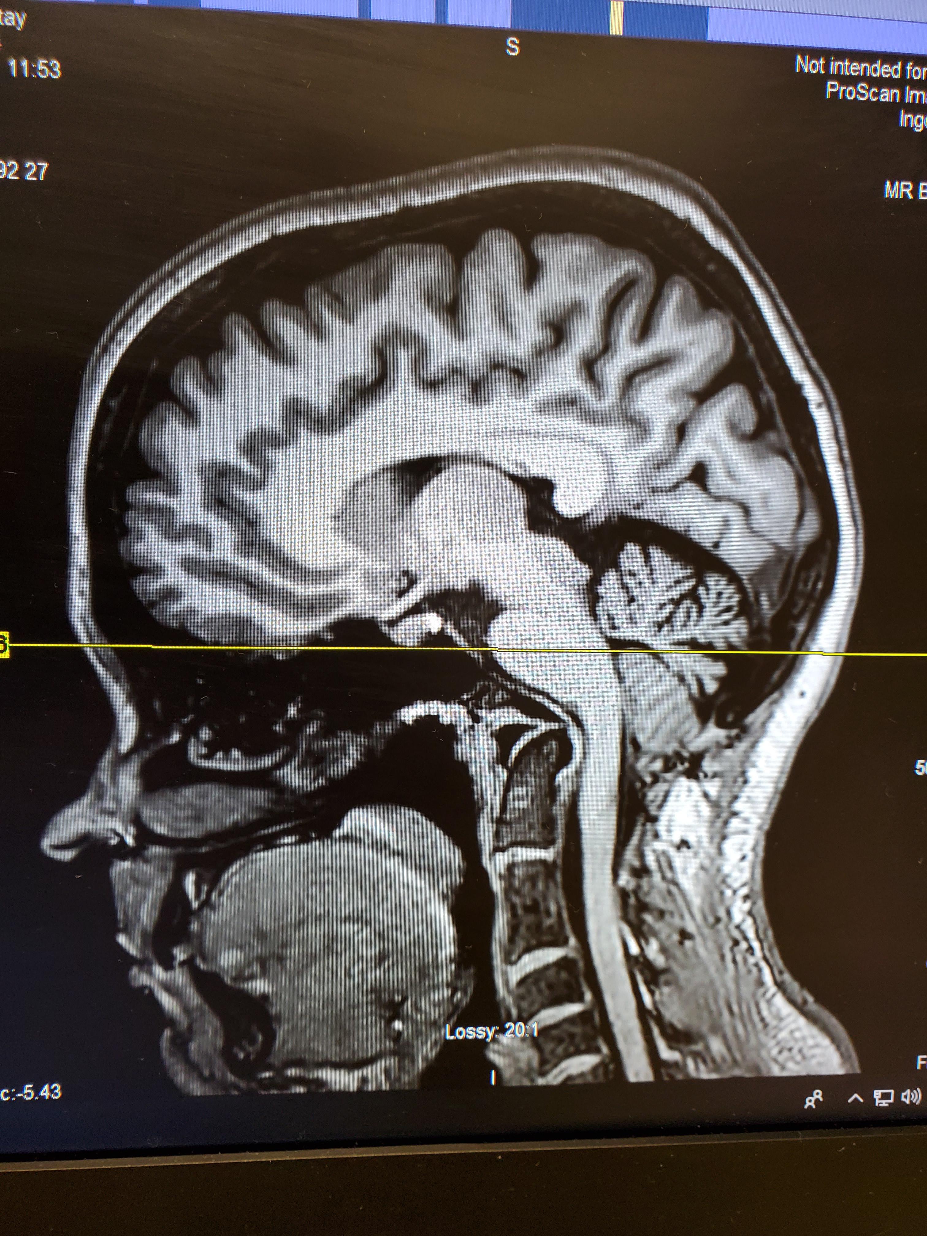 Neurosurgeon said my symptoms arent from my chiari and he doesnt know