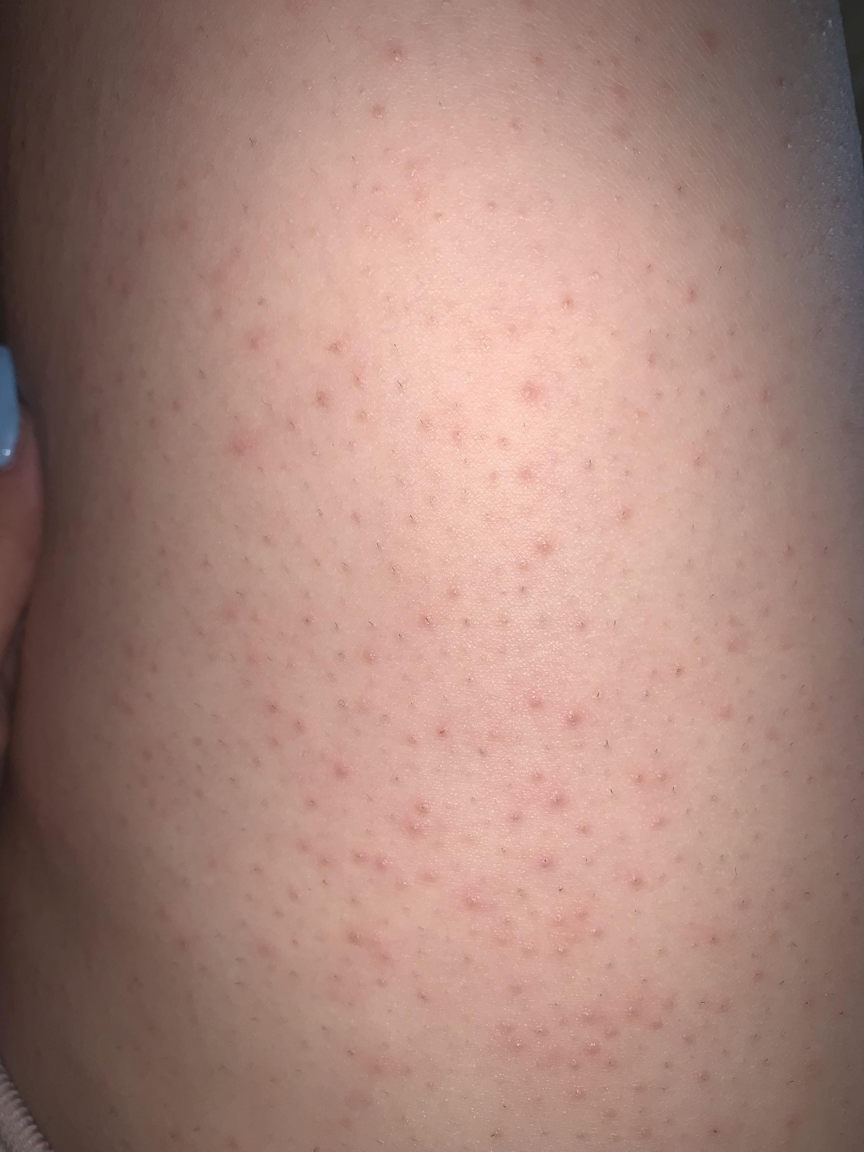 Help me!! I just realized that I’ve got these tiny red bumps on my leg