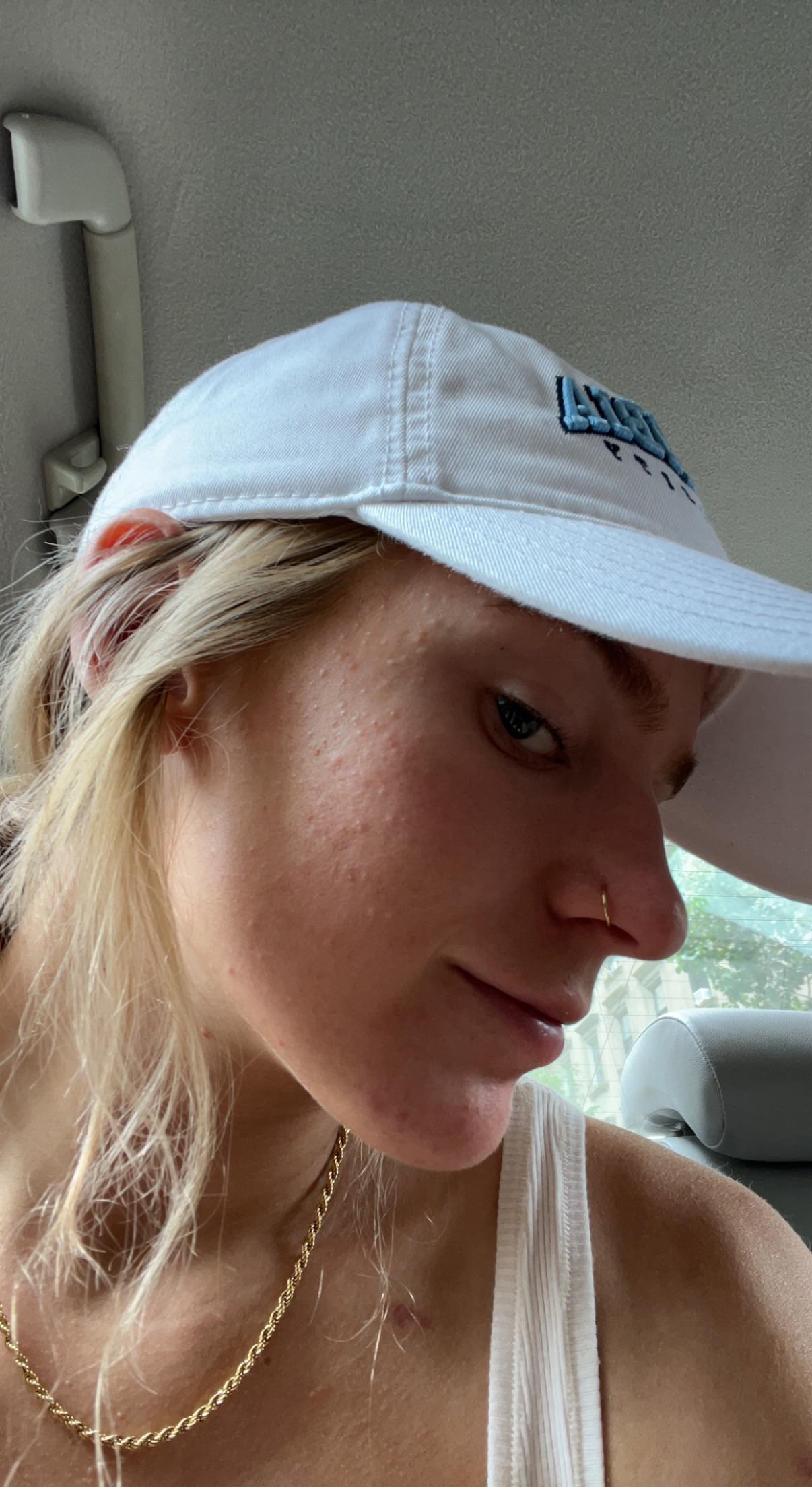 5 best u/erineec images on Pholder | Skincare Addicts, Tretinoin and Acne