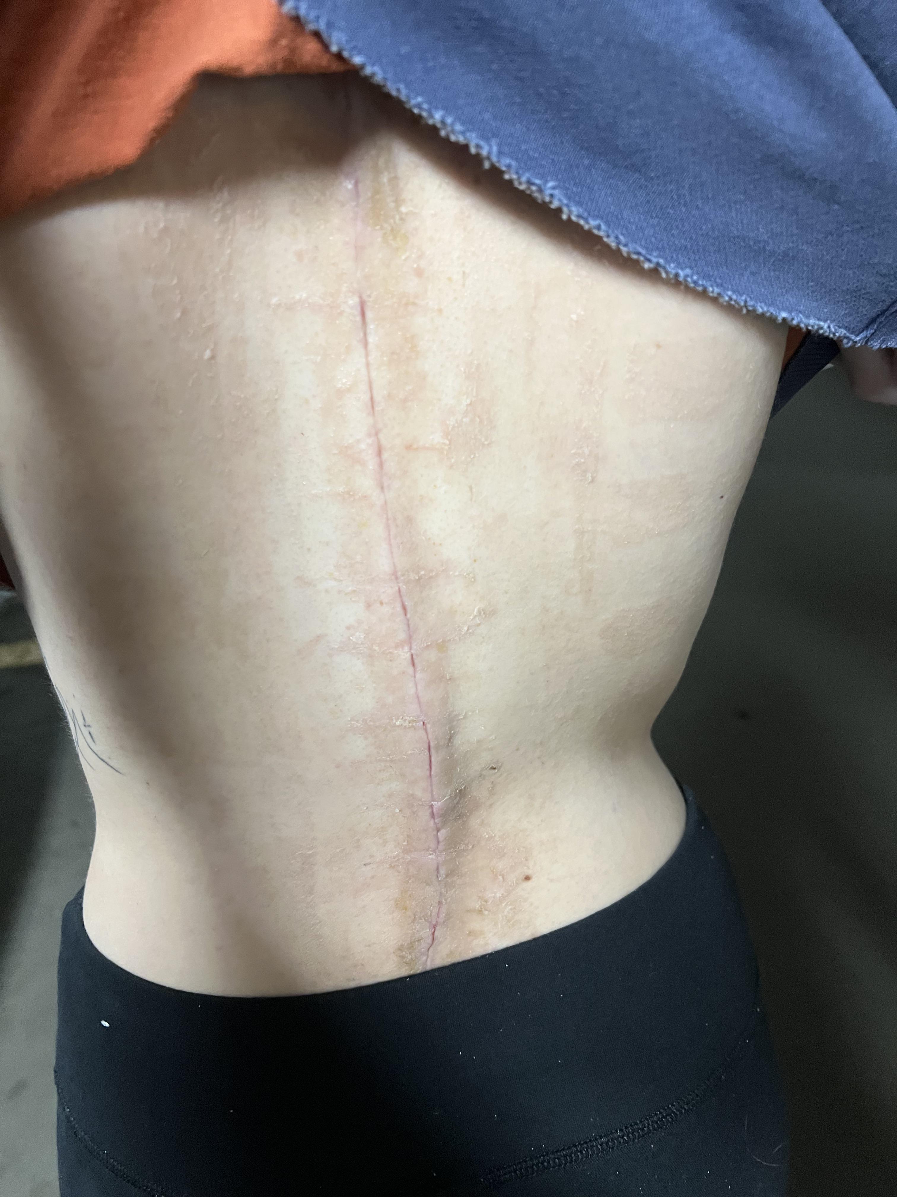 Two weeks post op scar r/scoliosis