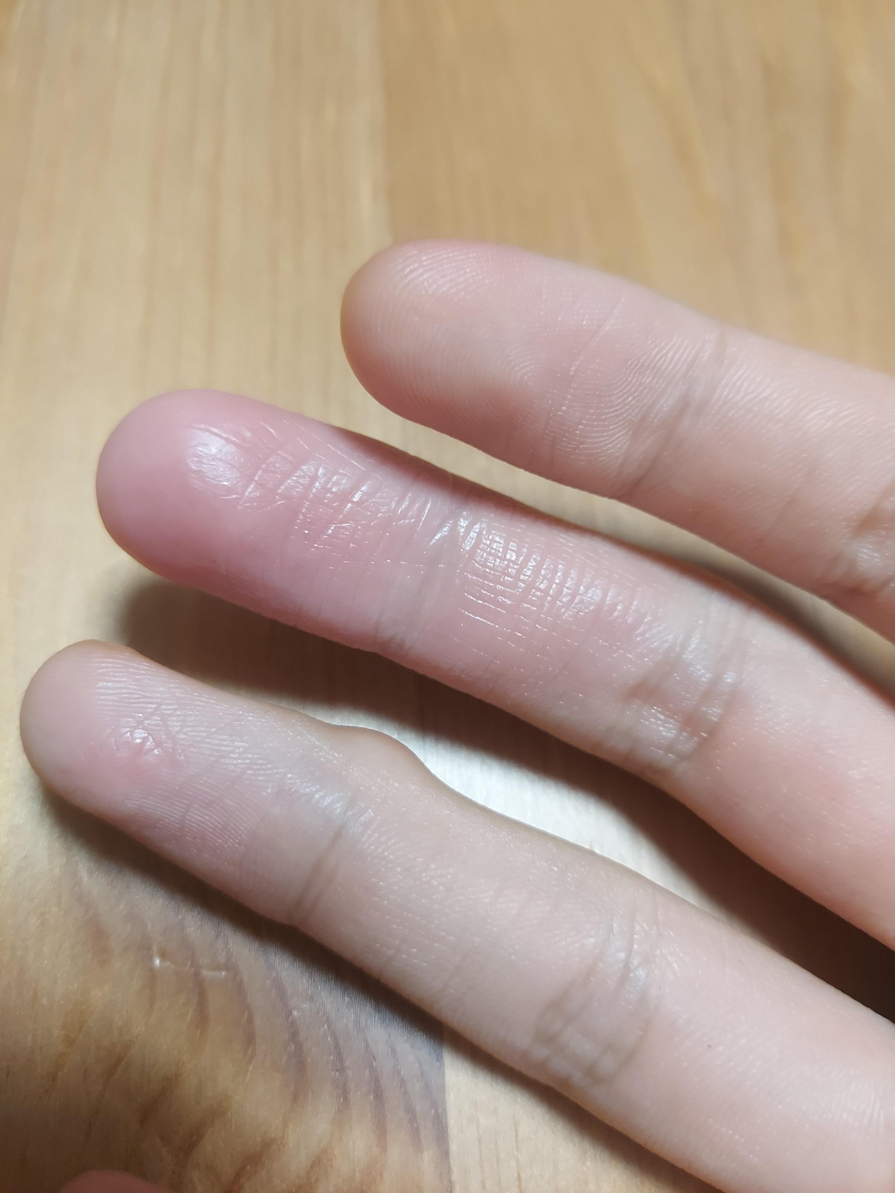 Dominant hand finger skin peeling and not growing back r